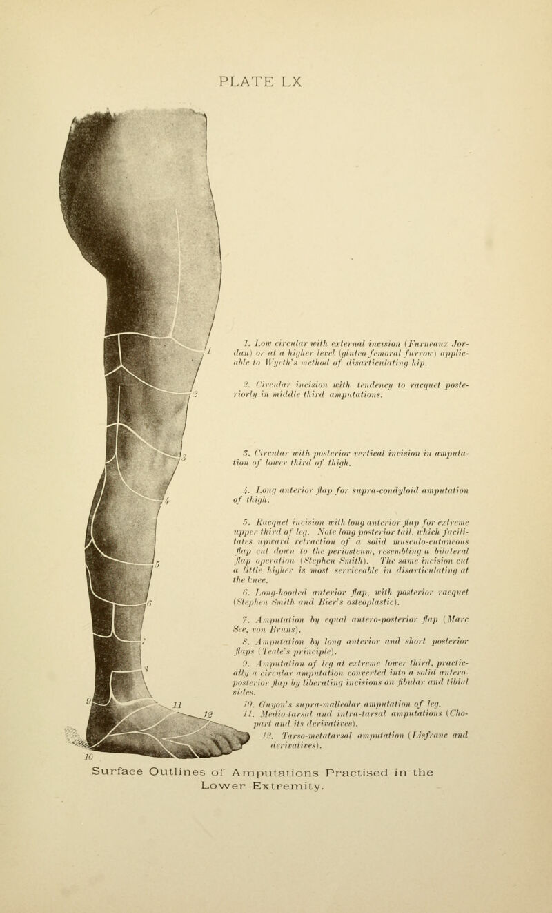 Surface Outli 1. Low ch'cidar with external incision (Fnrnennr Jor- iJ(in) or (it a hiijlier lerel (iiluieo-femoral furroir) iipplic- iihle to IVi/elli's method of disarticulating hip. 3. Circular incision with tendency to racquet poste- riorly in middle third amputations. 3. Circular with posterior vertical incision in amputa- tion of lower third of thigh. 4- Long anterior flap for supra-condyloid amputation of thigh. 5. Racquet incision with long anterior flap for extreme upper third of leg. Note long posterior tail, which facili- tates upward retraction of a solid muscido-ciitaneous flap cut down to the periosteum, resembling a bilateral flap operafion (f<tephen. Smith). The same incision cut a little higher is most serviceable in disarticulating at the knee. G. I^ong-hooded anterior flap, with posterior racquet (Fitephen Smith and Bier^s osteoplastic). 7. Amputation by equal antero-posterior flap (Marc See, von Bruus). 8. Amputation by long anterior and short posterior flaps (TeaMs principle). 9. Amputation of leg at crtreme lower third, practic- ally a circidar ampnfation converted into a solid antero- posterior Hup by liberating incisions on fibular and tibial sides. 10. G'uyon's supra.-malleolar amputation of leg. 11. Medio-tarsal and intra-tar.ial amputations (Cho- part and if^ derittatives). ■J /?. Tarso-metatarsal amputation (Lisfranc and r derii^afives). nes of Amputations Practised in the Lower Extremity.