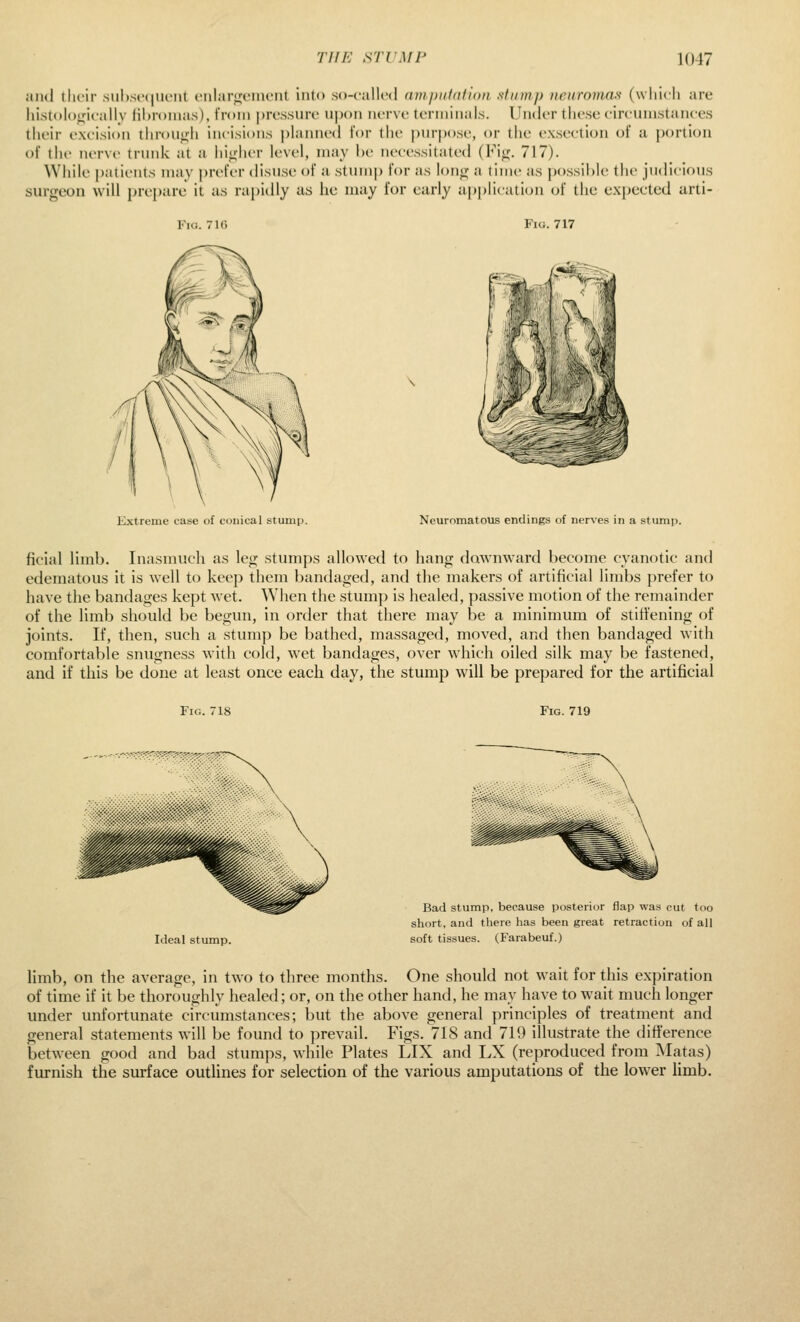 Jiiid tlicir .sul>si'(|Mc'iil ciiliirixciiu'iit into so-called (inipiitdfion .stump neuromas (wliicli are liistolof^icallv lihroiiias), from prcssuiv upon nrrvi- tcnniiiaLs. Under tlie.se eireuinstaiices their exeisioii tliroui«;li incisions i)lanned for the |)nr|)ose, or tiie exseetion of a portion of the nerve trnnk at a hi^dier level, may he necessitated {¥\g. 717). While j)atients may prefer disnse of a stnmp for as lonii; a time as possil)le the jndicions surgeon will pre{)are it as rapidly as he may for early application of the expected arti- Fio. 71G Fiu. 717 Extreme case of conical stump. Neuromatous endings of nerves in a stump. ficial Hmb. Inasmuch as leg stumps allowed to hang downwarfl become cyanotic and edematous it is well to keep them bandaged, and the makers of artificial limbs prefer to have the bandages kept wet. When the stump is healed, passive motion of the remainder of the limb should be begun, in order that there may be a minimum of stiti'ening of joints. If, then, such a stump be bathed, massaged, moved, and then bandaged with comfortable snugness with cold, wet bandages, over which oiled silk may be fastened, and if this be done at least once each day, the stump will be prepared for the artificial Fig. 718 Fig. 719 Ideal stump. Bad stump, because posterior flap was cut t<io short, and there has been great retraction of all soft tissues. (Farabeuf.) limb, on the average, in two to three months. One should not wait for this expiration of time if it be thoroughly healed; or, on the other hand, he may have to wait much longer under unfortunate circumstances; but the above general principles of treatment and general statements will be found to prevail. Figs. 718 and 719 illustrate the difference between good and bad stumps, while Plates LIX and LX (reproduced from Matas) furnish the surface outlines for selection of the various amputations of the lower limb.