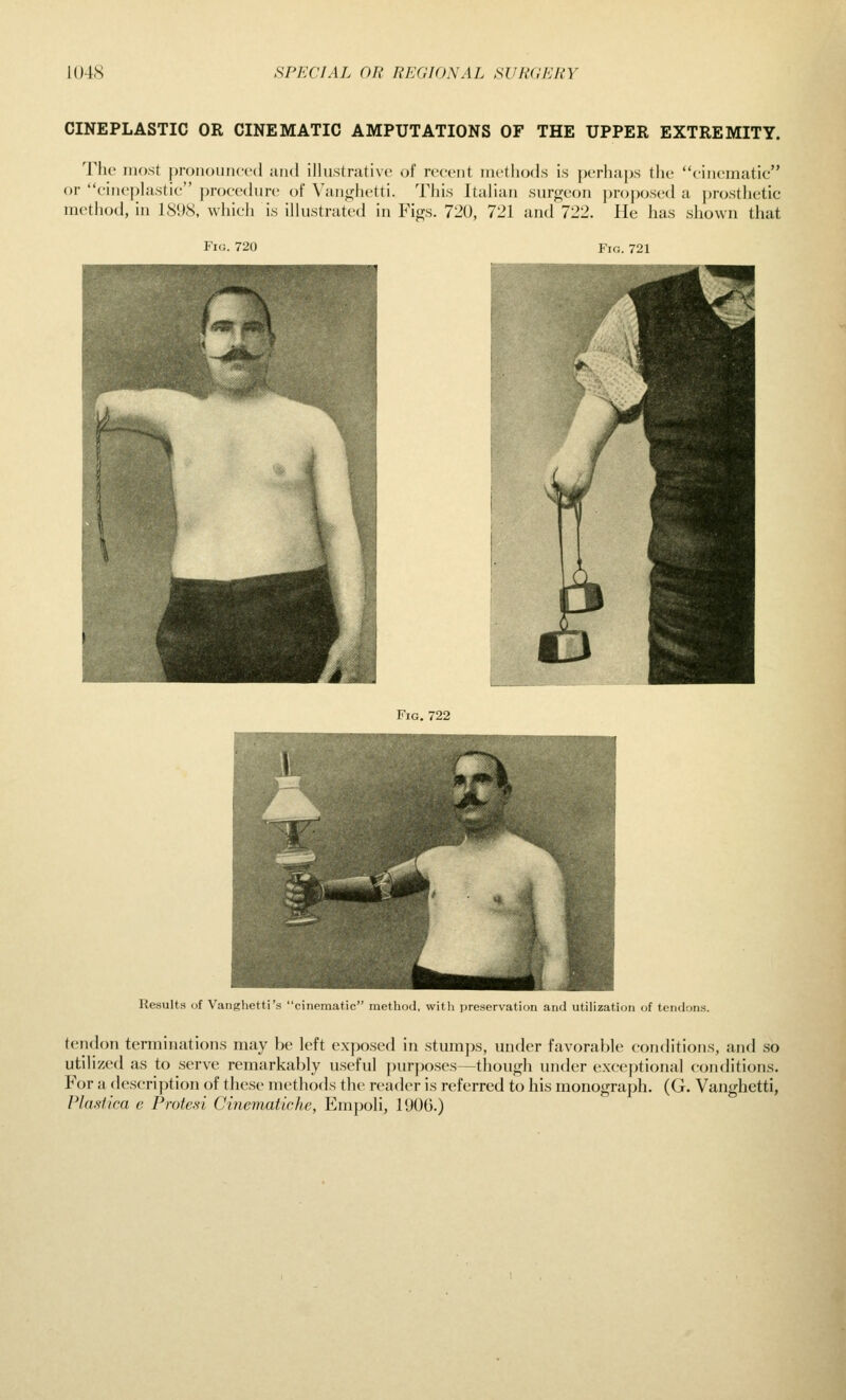 CINEPLASTIC OR CINEMATIC AMPUTATIONS OF THE UPPER EXTREMITY. The most pronounced jind illustrative of recent methods is perhaps the cinematic or cinej)lastic j)roce(lure of Vanghetti. This Italian surgeon |)roposed a j)rosthetic method, in 1898, which is illustrated in Figs. 720, 721 and 722. He has shown that Fig. 720 Fig. 721 Fig. 722 Results i)f Vanghetti's cinematic method, with preservation and utilization of tendons. tendon terminations may be left exposed in stumps, under favorable conditions, and so utihzed as to serve remarkably useful jnirposes—though under exceptiojial conditions. For a description of these methods the reader is referred to his monograph. (G. Vanghetti, Pla.siica e Prated Cinematiche, Empoli, 190G.)