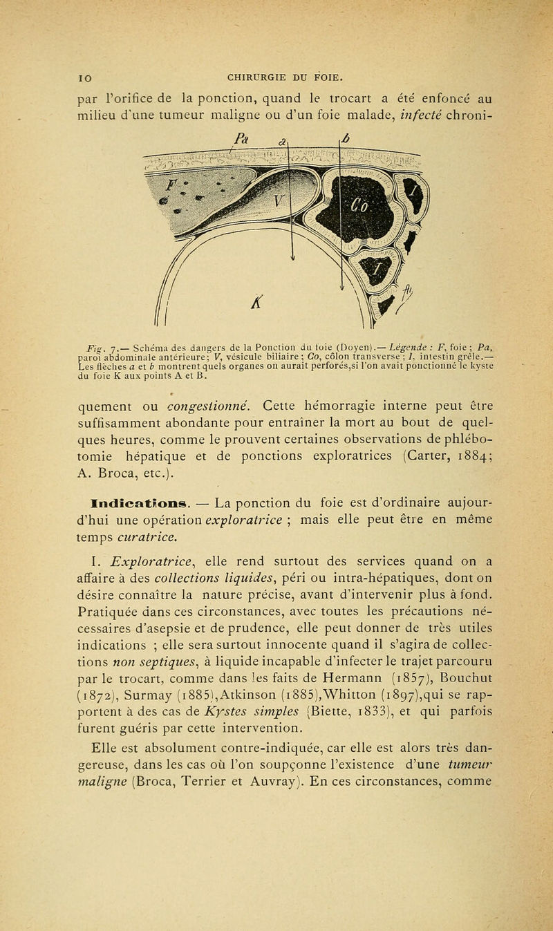 par l'orifice de la ponction, quand le trocart a été enfoncé au milieu d'une tumeur maligne ou d'un foie malade, infecté chroni- Fig. 7.— Schéma des dangers de la Ponction du foie (Doyen).— Légende : F, foie ; Pa, paroi abdominale antérieure; V, vésicule biliaire ; Co, côlon transverse ; 7, intestin grêle.— Les flèches a et b montrent quels organes on aurait perforés,si l'on avait ponctionné le kyste du foie K aux points A et B. quement ou congestionné. Cette hémorragie interne peut être suffisamment abondante pour entraîner la mort au bout de quel- ques heures, comme le prouvent certaines observations de phlébo- tomie hépatique et de ponctions exploratrices (Carter, 1884; A. Broca, etc.). Indications. — La ponction du foie est d'ordinaire aujour- d'hui une opération exploratrice ; mais elle peut être en même temps curatrice. I. Exploratrice, elle rend surtout des services quand on a affaire à des collections liquides, péri ou intra-hépatiques, dont on désire connaître la nature précise, avant d'intervenir plus à fond. Pratiquée dans ces circonstances, avec toutes les précautions né- cessaires d'asepsie et de prudence, elle peut donner de très utiles indications ; elle sera surtout innocente quand il s'agira de collec- tions non septiques, à liquide incapable d'infecter le trajet parcouru par le trocart, comme dans les faits de Hermann (1857), Bouchut (1872), Surmay (i885),Atkinson (i885),Whitton (1897),qui se rap- portent à des cas de Kystes simples (Biette, 1833), et qui parfois furent guéris par cette intervention. Elle est absolument contre-indiquée, car elle est alors très dan- gereuse, dans les cas où l'on soupçonne l'existence d'une tumeur maligne (Broca, Terrier et Auvray). En ces circonstances, comme