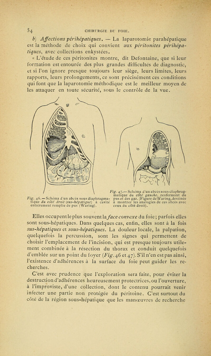 b) Affections périhépatiques. — La laparotomie parahépatique est la méthode de choix qui convient aux péritonites périhépa- tiques, avec collections enkystées. « L'étude de ces péritonites montre, dit Defontaine, que si leur formation est entourée des plus grandes difficultés de diagnostic, et si l'on ignore presque toujours leur siège, leurs limites, leurs rapports, leurs prolongements, ce sont précisément ces conditions qui font que la laparotomie méthodique est le meilleur moyen de les attaquer en toute sécurité, sous le contrôle de la vue. Fig. 47.— Schéma d'un abcès sous-diaphrag- matique du coté gauche, renfermant du Fig. 46. — Schéma d'un abcès sous diaphragma- pus et des gaz. (Figure deWaring, destinée tique du côté droit (sus-hépatique) à cavité à montrer les analogies de ces abcès avec entièrement remplie de pus (Waring). ceux du côté droit). Elles occupentleplus souvent la/ace convexe du foie; parfois elles sont sous-hépatiques. Dans quelques cas, enfin, elles sont à la fois sus-hépatiques et sous-hépatiques. La douleur locale, la palpation, quelquefois la percussion, sont les signes qui permettent de choisir remplacement de l'incision, qui est presque toujours utile- ment combinée à la résection du thorax et conduit quelquefois d'emblée sur un point du foyer (Fig. 4.6 et 47). S'il n'en est pas ainsi, l'existence d'adhérences à la surface du foie peut guider les re- cherches. C'est avec prudence que l'exploration sera faite, pour éviter la destruction d'adhérences heureusement protectrices, ou l'ouverture, à l'improviste, d'une collection, dont le contenu pourrait venir infecter une partie non protégée du péritoine. C'est surtout du côté de la région sous-hépatique que les manœuvres de recherche