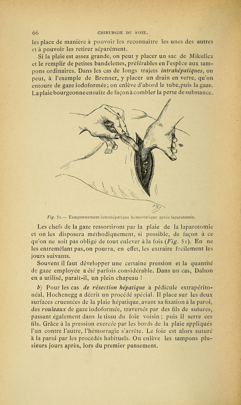les place de manière à pouvoir les reconnaître les unes des autres et à pouvoir les retirer se'parément. Si la plaie est assez grande, on peut y placer un sac de Mikulicz et le remplir de petites bandelettes, préférables en l'espèce aux tam- pons ordinaires. Dans les cas de longs trajets intrahépatiques, on peut, à l'exemple de Brenner, y placer un drain en verre, qu'on entoure de gaze iodoformée; on enlève d'abord le tube,puis la gaze. Laplaiebourgeonneensuite de façon à combler la perte desubstance. Fig. 5i.— Tamponnement intrahépatique hémostatique après laparotomie. Les chefs de la gaze ressortiront par la plaie de la laparotomie et on les disposera méthodiquement, si possible, de façon à ce qu'on ne soit pas obligé de tout enlever à la fois {Fig. 5i). En ne les entremêlant pas,on pourra, en effet, les extraire facilement les jours suivants. Souvent il faut développer une certaine pression et la quantité de gaze employée a été parfois considérable. Dans un cas, Dalton en a utilisé, paraît-il, un plein chapeau ! b) Pour les cas de résection hépatique à pédicule extrapérito- néal, Hochenegg a décrit un procédé spécial. Il place sur les deux surfaces cruentées de la plaie hépatique, avant sa fixation à la paroi, des rouleaux de gaze iodoformée, traversés par des fils de sutures, passant également dans le tissu du foie voisin; puis il serre ces fils. Grâce à la pression exercée par les bords de la plaie appliqués l'un contre l'autre, l'hémorragie s'arrête. Le foie est alors suturé à la paroi par les procédés habituels. On enlève les tampons plu- sieurs jours après, lors du premier pansement.