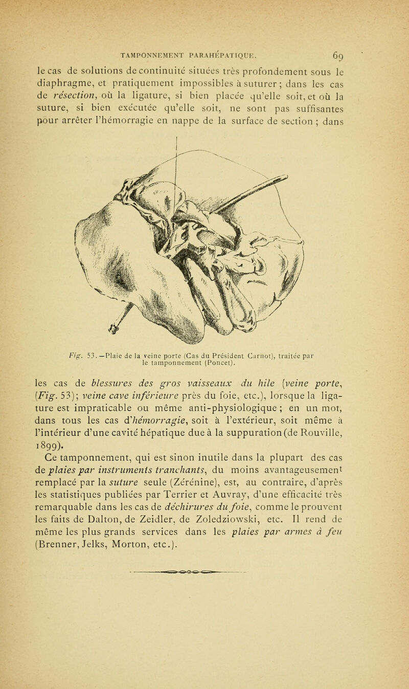 le cas de solutions de continuité situées très profondement sous le diaphragme, et pratiquement impossibles à suturer ; dans les cas de résection, où la ligature, si bien placée qu'elle soit, et où la suture, si bien exécutée qu'elle soit, ne sont pas suffisantes pour arrêter l'hémorragie en nappe de la surface de section ; dans Fig. 53.—Plaie de la veine porte (Cas du Président Carnot), traitée par le tamponnement (Poncet). les cas de blessures des gros vaisseaux du hile [veine porte, [Fig. 53); veine cave inférieure près du foie, etc.), lorsque la liga- ture est impraticable ou même anti-physiologique ; en un mot, dans tous les cas d'hémorragie, soit à l'extérieur, soit même à l'intérieur d'une cavité hépatique due à la suppuration (de Rouville, 1899). Ce tamponnement, qui est sinon inutile dans la plupart des cas de plaies par instruments tranchants, du moins avantageusement remplacé par la suture seule (Zérénine), est, au contraire, d'après les statistiques publiées par Terrier et Auvray, d'une efficacité très remarquable dans les cas de déchirures du foie, comme le prouvent les faits de Dalton, de Zeidler, de Zoledziowski, etc. Il rend de même les plus grands services dans les plaies par armes à feu (Brenner, Jelks, Morton, etc.).
