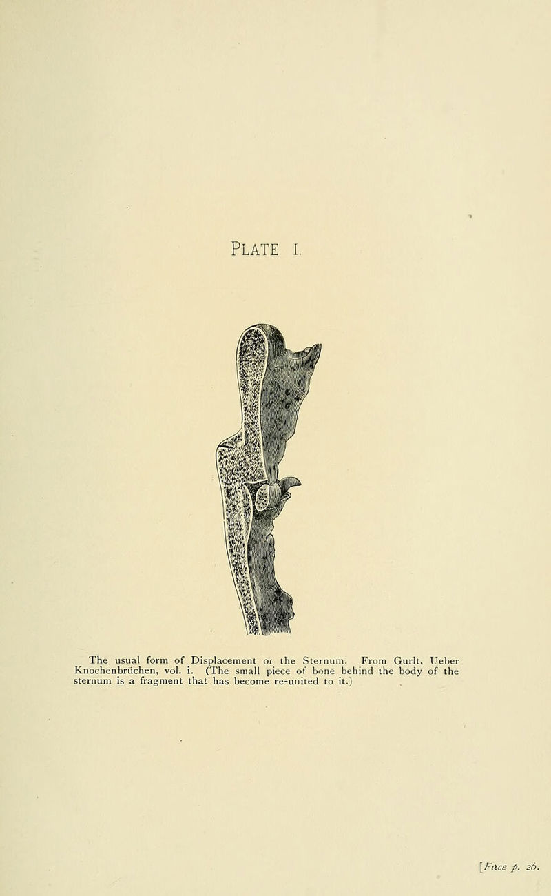 Plate i. .,1 '<r < The usual form of Displacement or the Sternum. From Gurlt, Ueber Knochenbriichen, vol. i. (The small piece of bone behind the body of the sternum is a fragment that has become re-united to it.) [Fttce fi. 26.