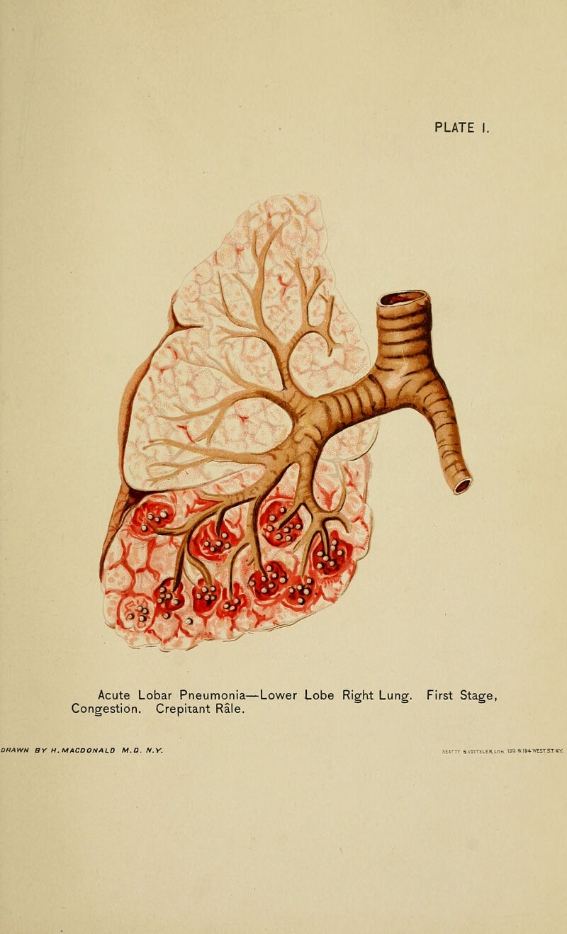 PLATE I. Acute Lobar Pneumonia—Lower Lobe RigKt Lung. First Stage, Congestion. Crepitant Rale. DRAWN BY H.MACDONALO M.O. N.Y.