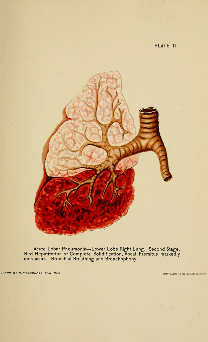Acute Lobar Pneumonia—Lower Lobe Right Lung. Secqnd Stage, Red Hepatization or Complete Solidification, Vocal Fremitus markedly increased. Bronchial Breathing and Bronchophony. DRAWN BY H.MACDONALO M.D.N.Y.