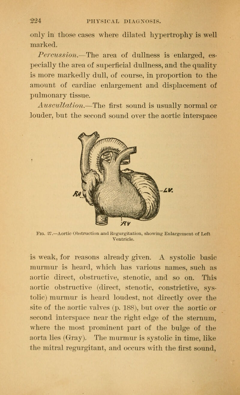 only in those cases where dilated hypertrophy is well marked. Percussion.—The area of dullness is enlarged, es- pecially the area of suj^erhcial dullness, and the quality is more markedly dull, of course, in proportion to the amount of cardiac enlargement and disx)lacement of pulmonary tissue. Auscultation.—The first sound is usually normal or louder, but the second sound over the aortic interspace /iV Fig. 27.—Aortic Obstruction and iiegurgitatiou, showing Enlargement of Left Ventricle. is weak, for reasons already given. A systolic basic murmur is heai-d, which has various names, such as aortic direct, obstructive, stenotic, and so on. This aortic obstructive (direct, stenotic, constrictive, sys- tolic) murmur is heard loudest, not directly over the site of the aortic valves (p. 188), but over the aortic or second interspace near the right edge of the sternum, where the most pronnnent joart of the bulge of the aorta lies (Gray). The murmur is systolic in time, like the mitral regurgitant, and occurs with the first sound,