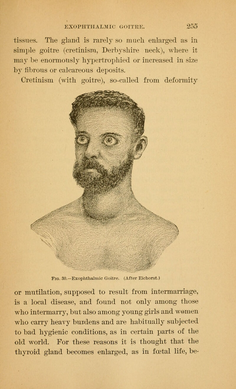 tissues. The gland is rarely so mLich enlarged as in simple goitre (cretinism, Derbyshire neck), where it ma3^ be enormously hypertroj^hied or increased in size by fibrous or calcareous deposits. Cretinism (with goitre), so-called from deformity Fig. 30.—Exophthalmic Goitre. (After Eichorst.) or mutilation, supposed to result from intermarriage, is a local disease, and found not only among those who intermarry, but also among young girls and women who carry heavy burdens and are habitually subjected to bad hygienic conditions, as in certain parts of the old world. For these reasons it is thought that the thyroid gland becomes enlarged, as in foetal life, be-