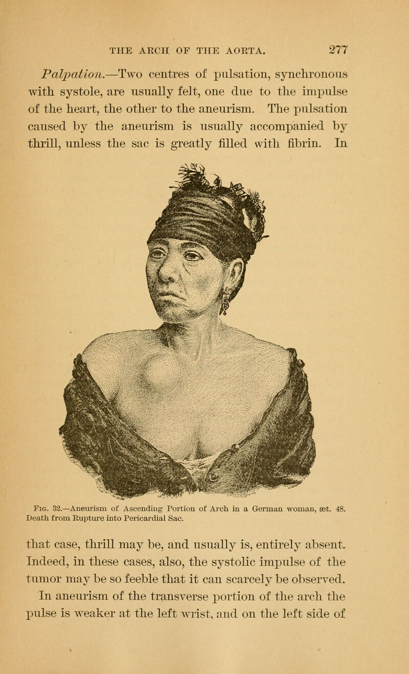 Palpation.—Two centres of iDiilsation, synchronous with systole, are usually felt, one due to the impulse of the heart, the other to the aneurism. The pulsation caused by the aneurism is usually accompanied by thrill, unless the sac is greatly filled with fibrin. In Fig. 32.—Aneurism of Ascending Portion of Arch in a German woman, set. 48. Death from Ruptm-e into Pericardial Sac. that case, thrill may be, and usually is, entirely absent. Indeed, in these cases, also, the systolic impulse of the tumor may be so feeble that it can scarcely be observed. In aneurism of the transverse portion of the arch the pulse is weaker at the left wrist, and on the left side of