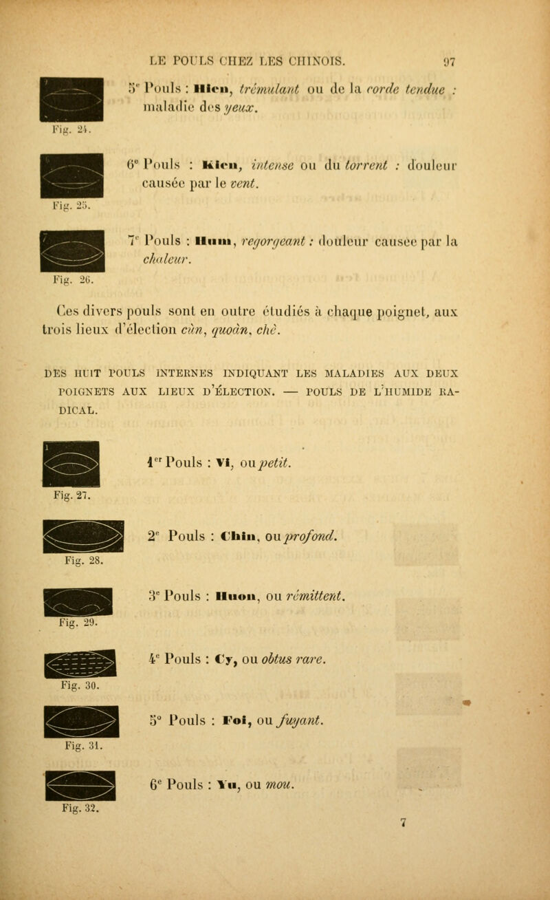 .■)' Pouls : iiitMi, trémulant ou de la corde tendue maladie ài'Syeux. Fit:. 6 Pouls : Kicii, intense ou du torrent : douleur causée par le vent. T Pouls : lliiiii, regorgeant: douleur causée par la ch(dcur. V\ii. ■!(>. (iCs divers pouls sont eu outre étudiés à chaque poignet, aux trois lieux d'élection cim, quoàn, chc. DES HUIT POULS INTERNES INDIQUANT LES MALADIES AUX DEUX rOIGNETS AUX LIEUX d'ÉLECTION. — POULS DE l'iIUMIDE RA- DICAL. 1 Pouls : VI, oupetit. Fig. 27. 2 Pouls : Cbiu, ou 2)ro/ond. Fi. 28. Fis. 29. 1^ Pouls : Hiioii, ou rémitterd. Fis. 30. Fis. 31. i Pouls : €y, ou obtus rare. 5° Pouls : Fol, Qw. fuyant. Fis. 32. 6*^ Pouls : Yh, ou mou.