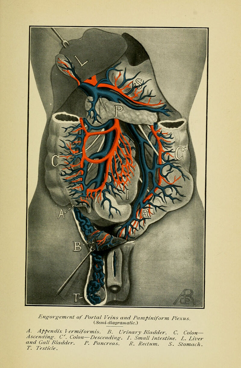 Engorgement of Portal Veins and Pampiniform Plexus. (Semi-diaoramatic.) A. Aff^endix lermiformis. B. Urinary Bladder. C. Colon- Ascending. C^. Coloji—Descending. I. Small Intestine. L. Liver and Gall Bladder. P. Pancreas. R. Rectum. S. Stomach. T. Testicle.
