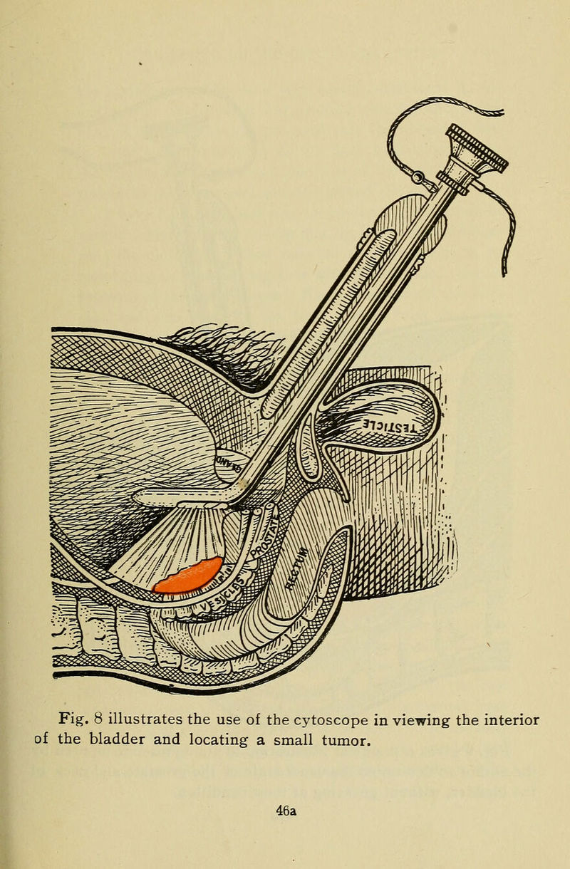 of the bladder and locating a small tumor. 46a