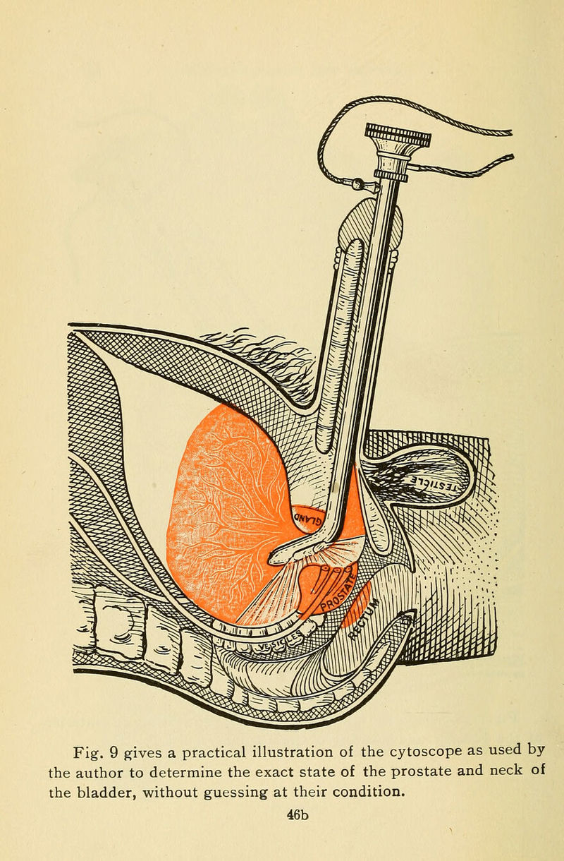 the author to determine the exact state of the prostate and neck of the bladder, without guessing at their condition. 46b