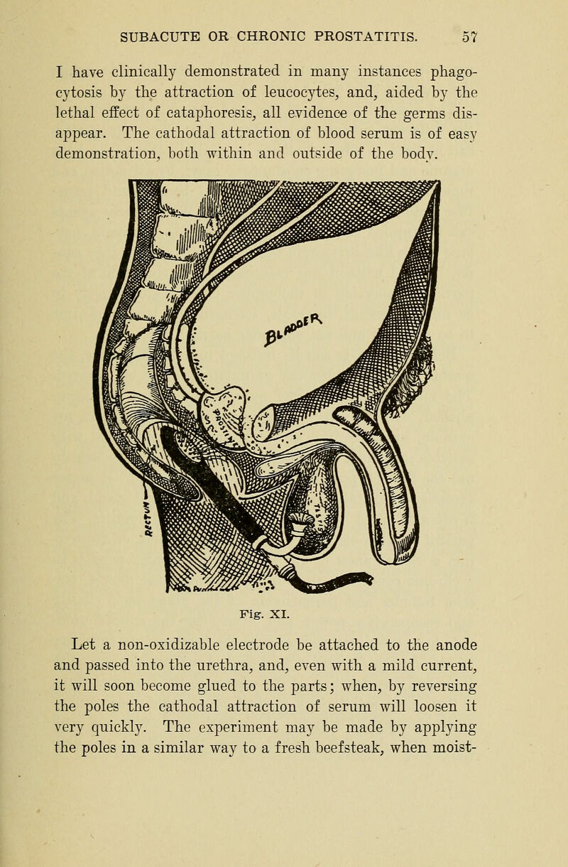 I have clinically demonstrated in many instances phago- cytosis by the attraction of leucocytes, and, aided by the lethal effect of cataphoresis, all evidence of the germs dis- appear. The cathodal attraction of blood serum is of easy demonstration, both within and outside of the bodv. Fig. XI. Let a non-oxidizable electrode be attached to the anode and passed into the urethra, and, even with a mild current, it will soon become glued to the parts; when, by reversing the poles the cathodal attraction of serum will loosen it very quickly. The experiment may be made by applying the poles in a similar way to a fresh beefsteak, when moist-