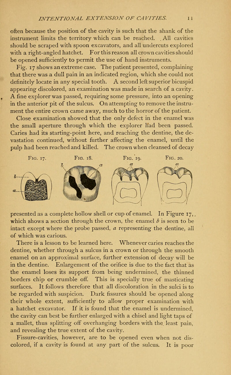 often because the position of the cavity is such that the shank of the instrument limits the territory which can be reached, . All cavities should be scraped with spoon excavators, and all undercuts explored with a right-angled hatchet. For this reason all crown cavities should be opened sufificiently to permit the use of hand instruments. Fig. 17 shows an extreme case. The patient presented, complaining that there was a dull pain in an indicated region, which she could not definitely locate in any special tooth. A second left superior bicuspid appearing discolored, an examination was made in search of a cavity. A fine explorer was passed, requiring some pressure, into an opening in the anterior pit of the sulcus. On attempting to remove the instru- ment the entire crown came away, much to the horror of the patient. Close examination showed that the only defect in the enamel was the small aperture through which the explorer had been passed. Caries had its starting-point here, and reaching the dentine, the de- vastation continued, without further affecting the enamel, until the pulp had been reached and killed. The crown when cleansed of decay Fig. 17. Fig. 18. Fig. 19. Fig. 20. presented as a complete hollow shell or cup of enamel. In Figure 17,, which shows a section through the crown, the enamel d is seen to be intact except where the probe passed, a representing the dentine, all of which was carious. There is a lesson to be learned here. Whenever caries reaches the dentine, whether through a sulcus in a crown or through the smooth enamel on an approximal surface, further extension of decay will be in the dentine. Enlargement of the orifice is due to the fact that as the enamel loses its support from being undermined, the thinned borders chip or crumble off. This is specially true of masticating surfaces. It follows therefore that all discoloration in the sulci is to be regarded with suspicion. Dark fissures should be opened along their whole extent, sufficiently to allow proper examination with a hatchet excavator. If it is found that the enamel is undermined, the cavity can best be further enlarged with a chisel and light taps of a mallet, thus splitting off overhanging borders with the least pain, and revealing the true extent of the cavity. Fissure-cavities, however, are to be opened even when not dis- colored, if a cavity is found at any part of the sulcus. It is poor