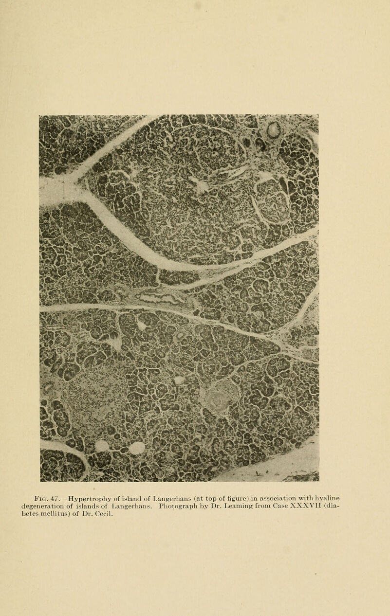 Fig. 47.—Hypertrophy of island of Langerlians (at top of figure) in association witli liyaline degeneration of islands of lyangerhans. Photograph by Dr. Learning from Case XXXVII (dia- betes mellitus) of Dr. Cecil.