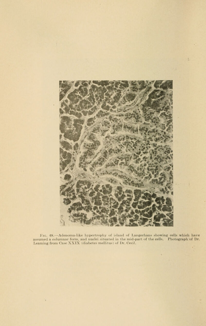 Fig. 48.—^Adeiioiiia-like hypertrophy of island of l.angerhans showing cells which have assumed a columnar form, and nuclei situated in the mid-part of tlie cells. Photograph'of Dr. Leaming from Case XXIX (diahotes mellilus) of Dr. (Veil.