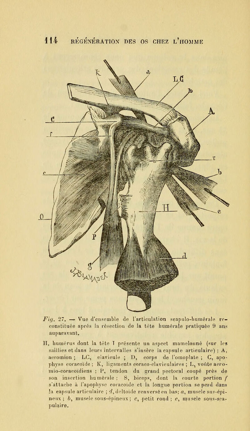 iL-J Fifi. 27. — Vue d'ensemble île l'articulation scapulo-humérale re- constituée après la résection de la tète numérale pratiquée 9 ans auparavant. II, humérus dont la tète T présente un aspect mamelonné (sur les saillies et dans leurs intervalles s'insère la capsule articulaire); A, aeromion ; LC, clavicule ; D, corps de l'omoplate ; C, apo- physe eoracoïde ; K, ligaments coraco-claviculaires ; L, voûte acro- mio-coracoidiens ; P, tendon du grand pectoral coupé près de son insertion humera le ; S, biceps, dont la courte portion f s'attache à l'apophyse coracoiile et la longue portion se perd dans !a capsule articulaire ; d, deltoïde renversé en bas; a, muscle sus-épi- neux ; b, muscle sous-épineux ; c, petit rond; e, muscle sons-sca- pulaire.