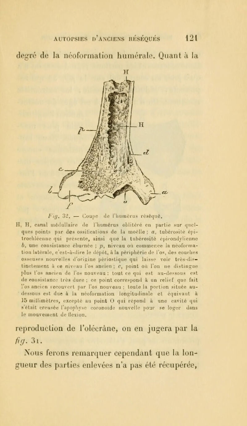 degré de la néoformation humérale. Quant à la g&v.< :.::■.:. ' Èi.*/' • i*- c /■ .i/. 32. — Coupe de l'humérus réséqua. II. H. canal médullaire île l'Iiumérus oblitéré en partie sur .jnu 1— qoes points par des ossilicalions de la moelle; a, lubérosité êpi- trocbléenne qui présente, ainsi que la lubérosité épicondylienno b. une consislani bnrnée : />. niveau ou commence la néoforma- tion latérale, c'est-à-dire le dépôt, à la périphérie de l'n-, des couches osseuses nouvelles d'origine périostique qui laisse voir très dis- tinctement à ce niveau l'os ancien : r, point oh l'on ne distingue plu* !'os ancien de l'os nouveau: toul ce qui est au-dessous est de consislanc ■ très dure ; ce point correspond à un relief que fait l'os ancien recouvert par l'os nouveau: loule la portion située au- dessous est ilur à la néoformation longitudinale et équivaut à 15 millimètres, excepté au point O qui répond à une cavité qui s'était creusée l'apophyse coronoide nouvelle pour se louer tians le mouvement de Qi reproduction de l'olécrâne, on en jugera par la fi g. 3i. Nous ferons remarquer cependant que la lon- gueur des parties enlevées n'a pas été récupérée,