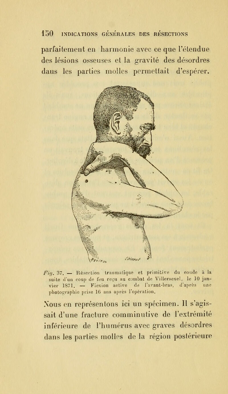 parfaitement en harmonie avec ce que l'étendue des lésions osseuses et la gravité des désordres daus les parties molles permettait d'espérer. FUj. 37. — Résection traumalique et primitive du coude à la suite d'un coup de feu reçu au combat de Villersexel, le 10 jan- vier 1871. — Flexion active de l'avant-bras, d'après une photographie prise 16 ans après l'opération. Nous en représentons ici un spécimen. Il s'agis- sait d'une fracture comminutive de l'extrémité inférieure de l'humérus avec graves désordres dans les parties molles de la région postérieure