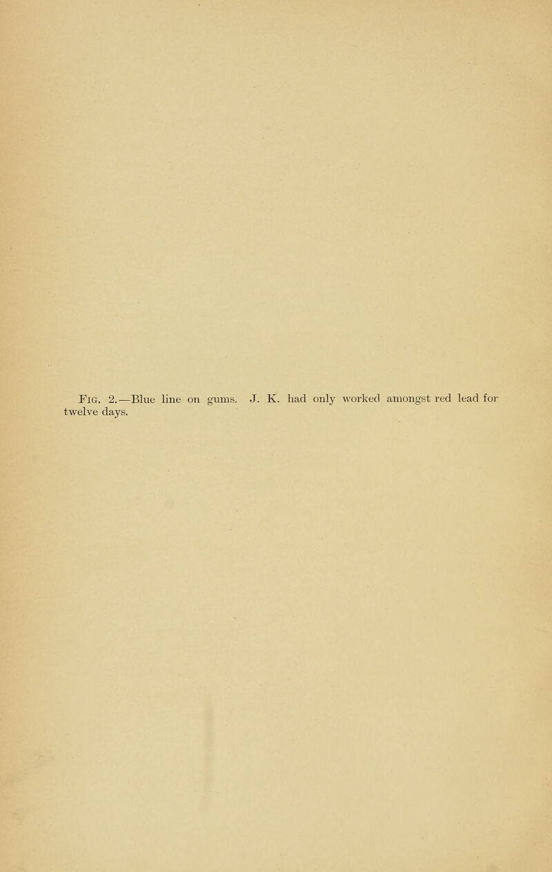 Fig. 2.-—Blue line on gums. J. K. had only worked amongst red lead for twelve days.