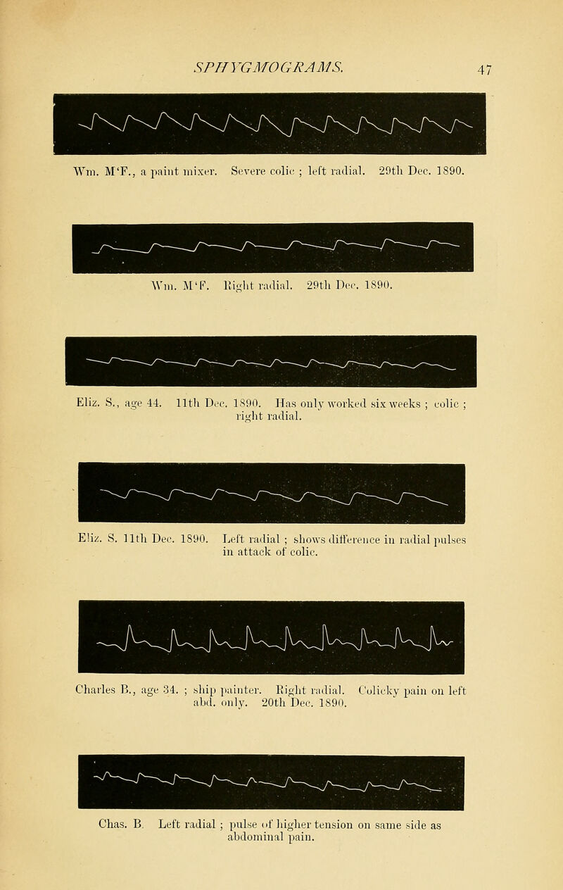 Wm. M'F., a paint inixt-r. Severe colic ; left radial. ■29th Dec. 1890. Win. M'F. Riglit radial. 29tli Dec, 1890. Eliz. S., age 44. 11th Dec. 1890. Has only worked six weeks ; colic ; rit^ht radial. Eliz. S. lltli Dec. 1890. Left radial ; shows diti'erence in radial pulses in attack of colic. Charles B., age 34. ; ship ]iainter. Eight radial. Colicky pain on left abd. only. 20th Dec. 1890. Clias. B. Left radial ; pulse of higher tension on same side as abdominal pain.