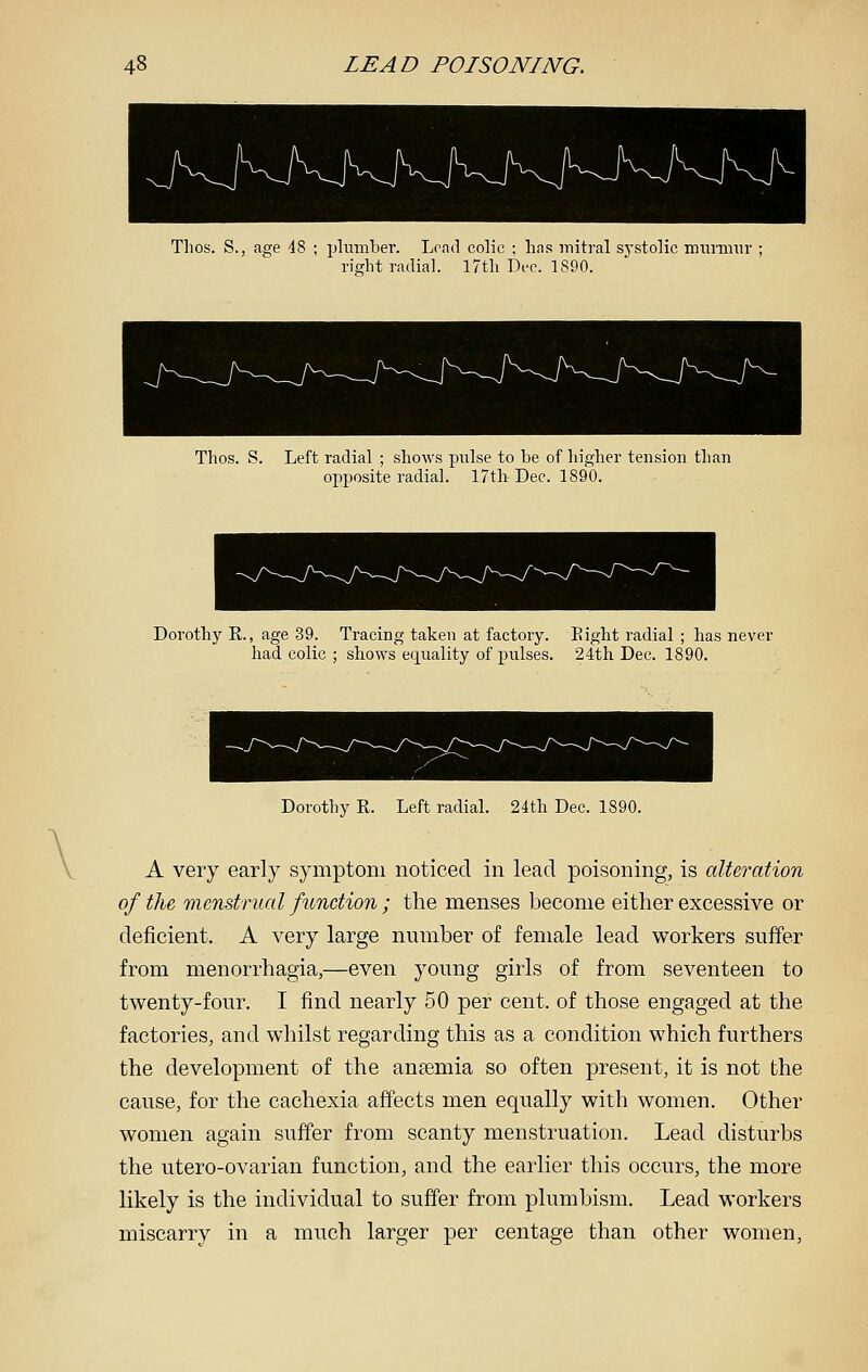 Tlios. S., age d8 ; plumber. Load colic : has mitral sj'stolic murmur right radial. 17th Dec. 1890. Thos. S. Left radial ; shows pulse to be of higher tension than opposite radial. 17th Dee. 1890. Dorothy R., age 39. Tracing taken at factory. Eight radial ; has never had colic ; shows equality of pulses. 24th Dec. 1890. Dorothy R. Left radial. 24th Dec. 1890. A very early symptom noticed in lead poisoning, is alteration of the menstrual function ; the menses become either excessive or deficient. A very large number of female lead workers suffer from menorrhagia,—even young girls of from seventeen to twenty-four. I find nearly 50 per cent, of those engaged at the factories, and whilst regarding this as a condition which furthers the development of the anaemia so often present, it is not the cause, for the cachexia affects men equally with women. Other women again suffer from scanty menstruation. Lead disturbs the utero-ovarian function, and the earlier this occurs, the more likely is the individual to suffer from plumbism. Lead workers miscarry in a much larger per centage than other women,