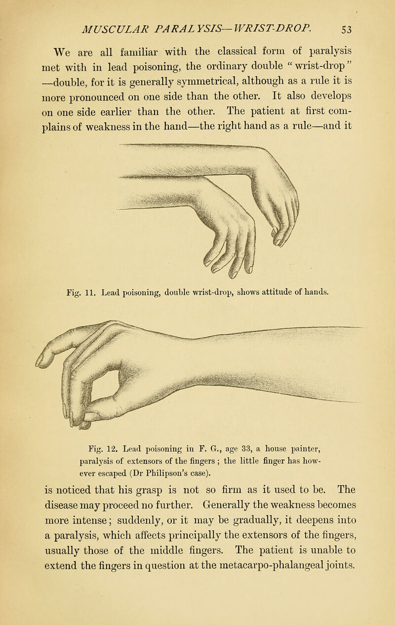 We are all familiar with the classical form of paralysis met with in lead poisoning, the ordinary double  wrist-drop —double, for it is generally symmetrical, although as a rule it is more pronounced on one side than the other. It also develops on one side earlier than the other. The patient at first com- plains of weakness in the hand—the right hand as a rule—and it JM;b■a^^5P^Sl■■J^^^^^■;^l■^i^^Bj^||Jal)^l^^lt^)ll,uj^^J■|yy Fig. 11. Lead poisoning, double wrist-drop, shows attitude of hands. Fig. 12. Lead poisoning in F. G., age 33, a house painter, paralysis of extensors of the fingers ; the little finger has how- ever escaped (Dr Philipson's case). is noticed that his grasp is not so firm as it used to be. The disease may proceed no further. Generally the weakness becomes more intense; suddenly, or it may be gradually, it deepens into a paralysis, which affects principally the extensors of the fingers, usually those of the middle fingers. The patient is unable to extend the fingers in question at the metacarpo-phalangeal joints.