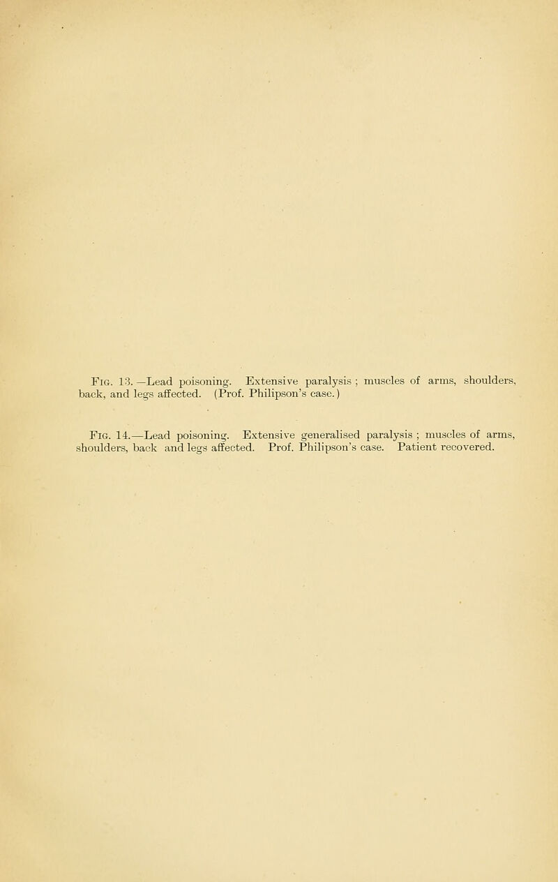 back, and legs affected. (Prof. Philipson's case.) Fig. 14.—Lead poisoning. Extensive generalised paralysis ; muscles of arms, shoulders, back and legs affected. Prof. Philipson's case. Patient recovered.