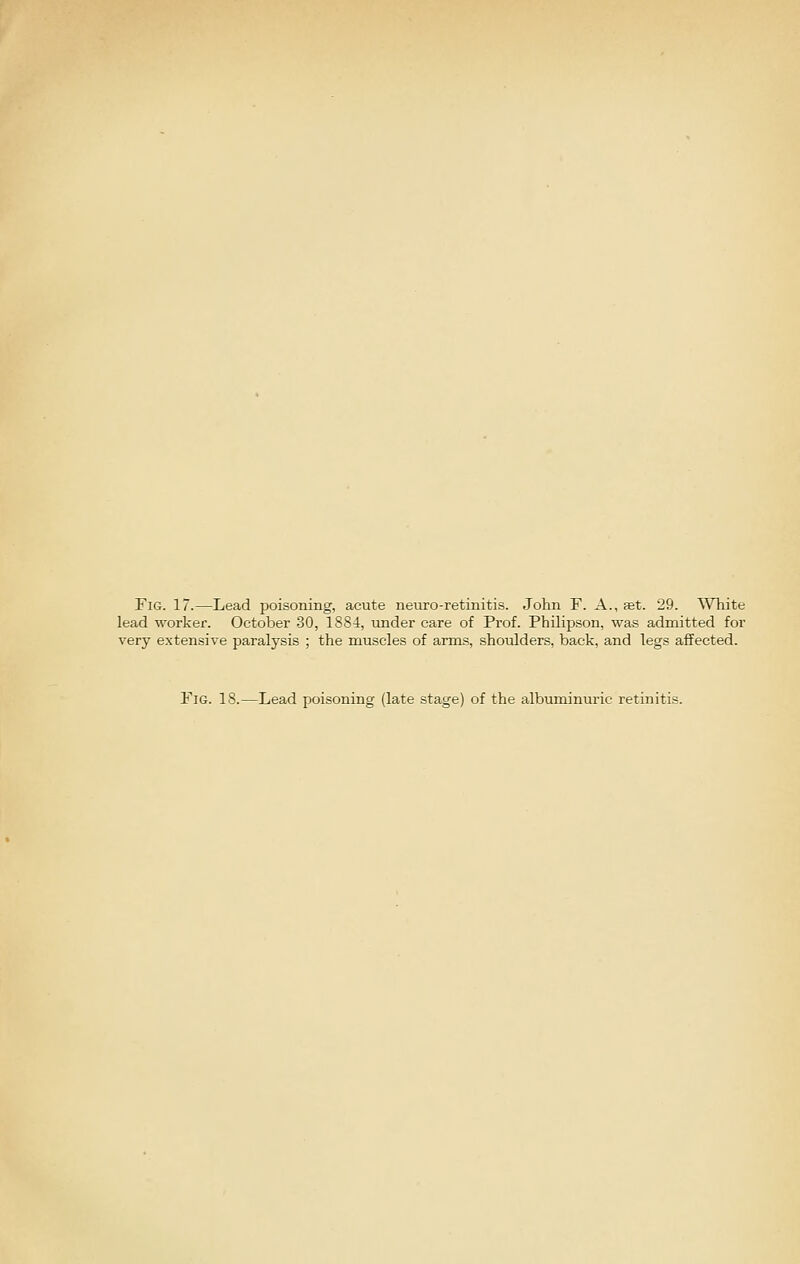 Fig. 17.—Lead poisoning, acute neuro-retinitis. John F. A., aet. 29. White lead worker. October 30, 1884, under care of Prof. Philipson, was admitted for very extensive paralysis ; the muscles of arms, shoulders, back, and legs affected. Fig. 18.—Lead poisoning (late stage) of the albuminuric retinitis.