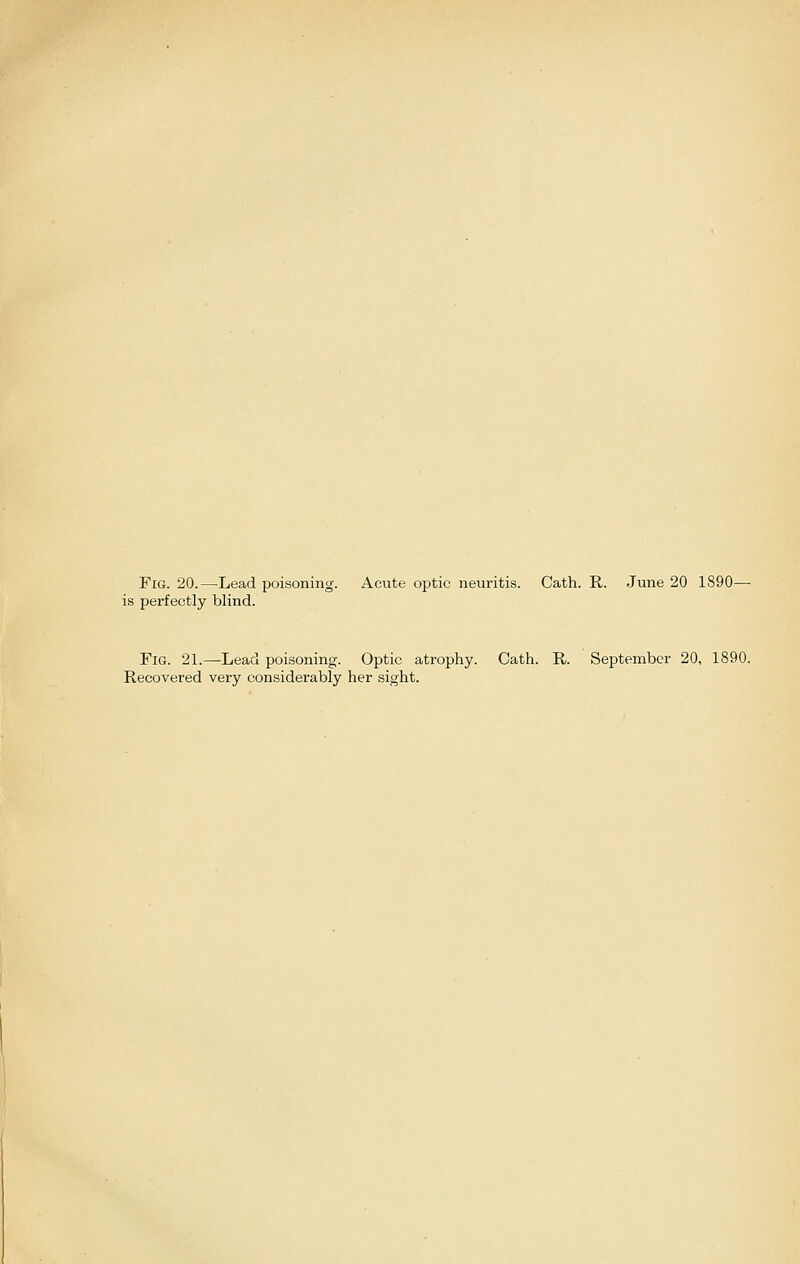 Fig. 20.—Lead poisoning. Acute optic neuritis. Cath. R. June 20 1890— is perfectly blind. Fig. 21.—Lead poisoning. Optic atrophy. Cath. R. September 20, 1890. Recovered very considerably her sight.