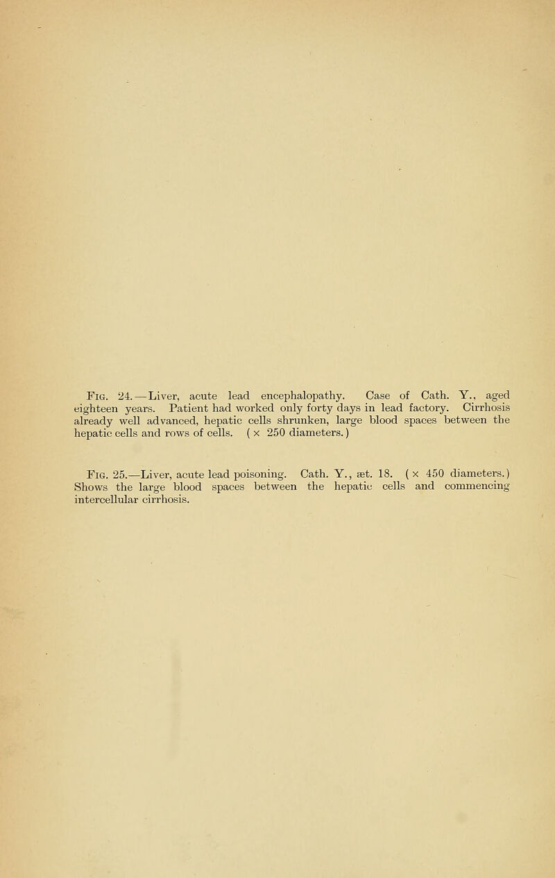 Fig. 24.—Liver, acute lead encephalopathy. Case of Cath. Y., aged eighteen years. Patient had worked only forty days in lead factory. Cirrhosis already well advanced, hepatic cells shrunken, large blood spaces between the hepatic cells and rows of cells. ( x 250 diameters.) Fig. 25.—Liver, acute lead poisoning. Cath. Y., set. 18. (x 450 diameters.) Shows the large blood spaces between the hepatic cells and commencing intercellular cirrhosis.