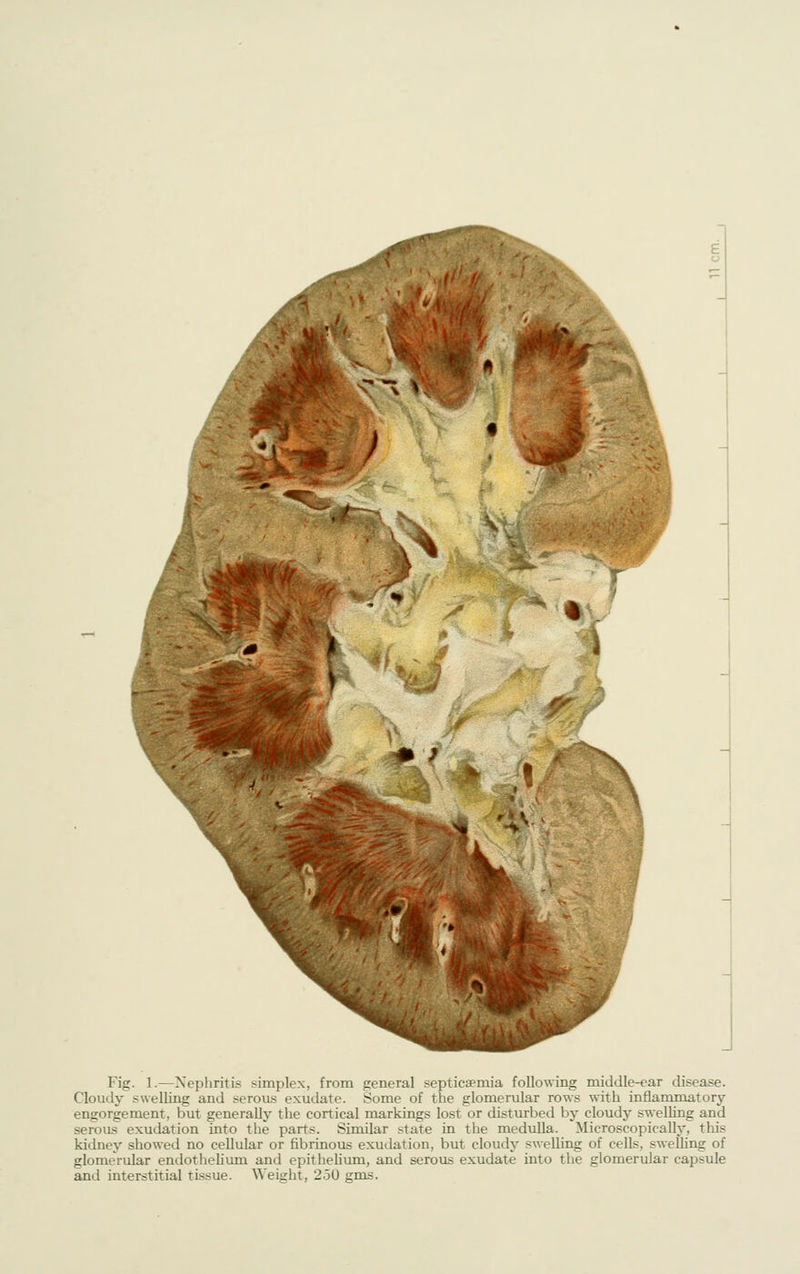 ^-, Fig. 1.—Nephritis simplex, from general septicaemia following middle-ear disease. Cloudy swelling and serous exudate. Some of the glomerular rows with inflammatory engorgement, but generally the cortical markings lost or disturbed by cloudy swelling and serous exudation into the parts. Similar state in the medulla. Microscopically, this kidney showed no cellular or fibrinous exudation, but cloudy swelling of cells, swelling of glomerular endothelium and epitheliimi, and serous exudate into the glomerular capsule and interstitial tissue. Weight, 250 gms.