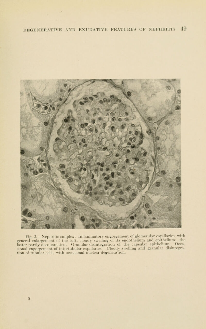 ^1 ; ^'i '- 1' 9 Fig. 2.—Xephritis .simplex: Inflammatory engorgement of glomerular capillaries, with general enlargement of the tuft, cloudy swelling of its endothehum and epitheUum; the latter partly desquamated. Granular disintegration of the capsular epitheUum. Occa- sional engorgement of intertuluilar capillaries. Cloudy swelhng and granular cUsintegra- tion of tubular cells, wiih occasional nuclear degeneration.