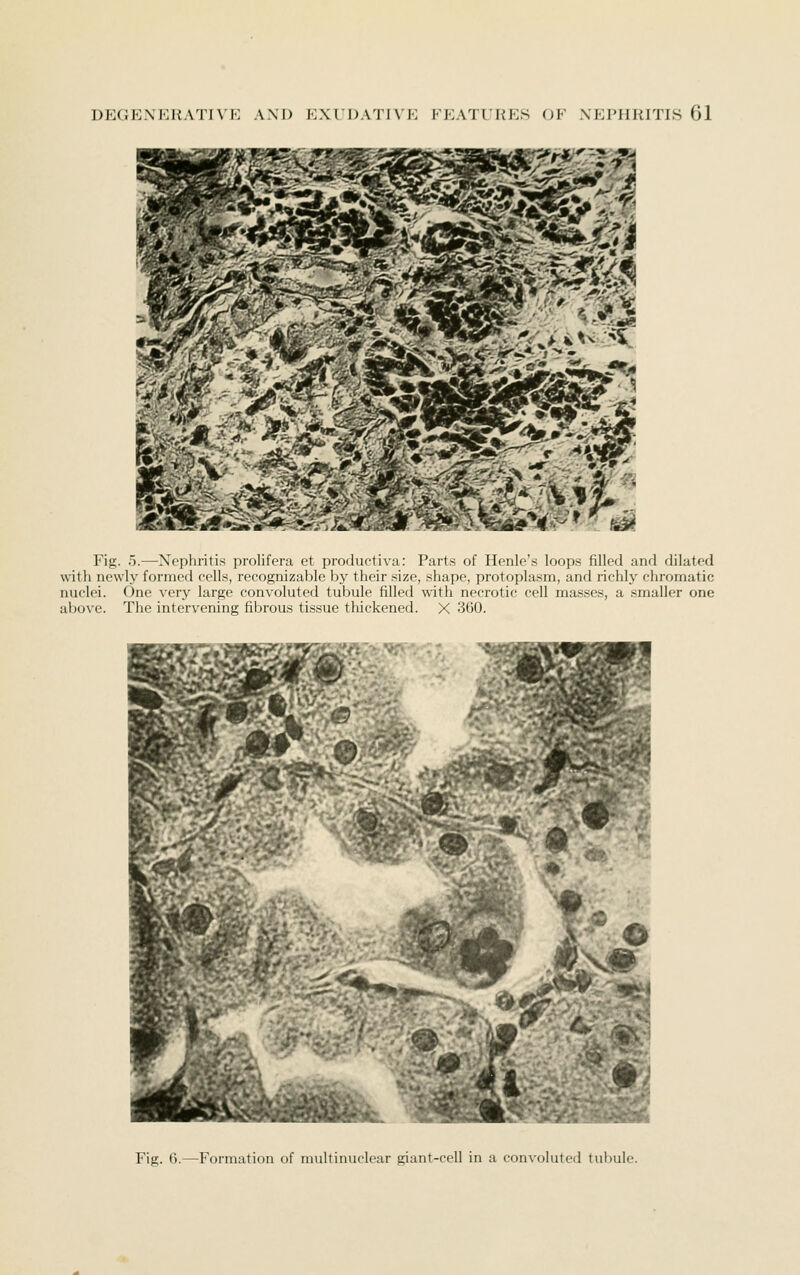 Fig. 0.—Xepliritis prolifera et productiva: Parts of Henle's loops filled and dilated witli newly formed cells, recognizable by their size, shape, protoplasm, and richly chromatic nuclei. One very large convoluted tubule filled with necrotic cell masses, a smaller one above. The intervening fibrous tissue thickened. X 360. & Fig. 6.—Formation of multinuclear giant-cell in a convoluted tubule.