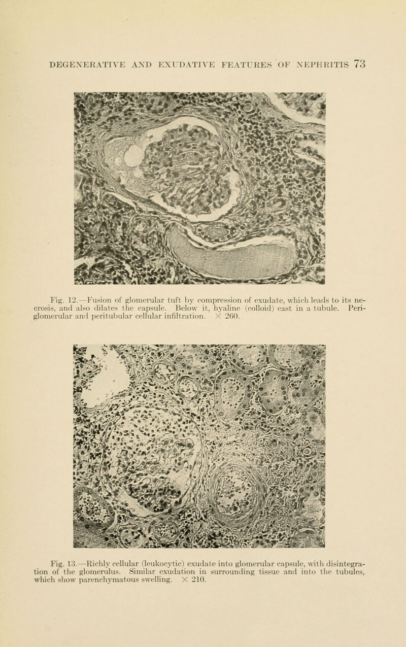 Fig. 12.—Fusion of glomerular tuft by compression of exudate, wliicli leads to its ne- crosis, and also dilates the capsule. Below it, hyaline (colloid) cast in a tubule. Peri- glomerular and peritubular cellular infiltration. X 260. Fig. 13.—Richly cellular (leukocytic) exudate into glomerular capsule, with disintegra- tion of the glomerulus. Similar exudation in surroimding tissue and into the tubules, which show parenchjanatous swelling. X 210.