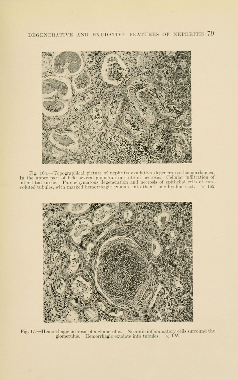 Fig. 16r/.—Topographical picture of nephritis exudativa degenerativa ha^morrhagica. In the upper part of field several glomeruli in state of necrosis. Cellular infiltration of interstitial tissue. Parenchymatous degeneration and necro.sis of epithelial cells of con- voluted tubules, with marked hemorrhagic exudate into them; one hyaUne cast. X 162 Fig. 17.—Hemorrhagic necrosis of a glomerulus. Necrotic inflammatory cells surround the glomerulus. Hemorrhagic exudate into tubules. X 125.