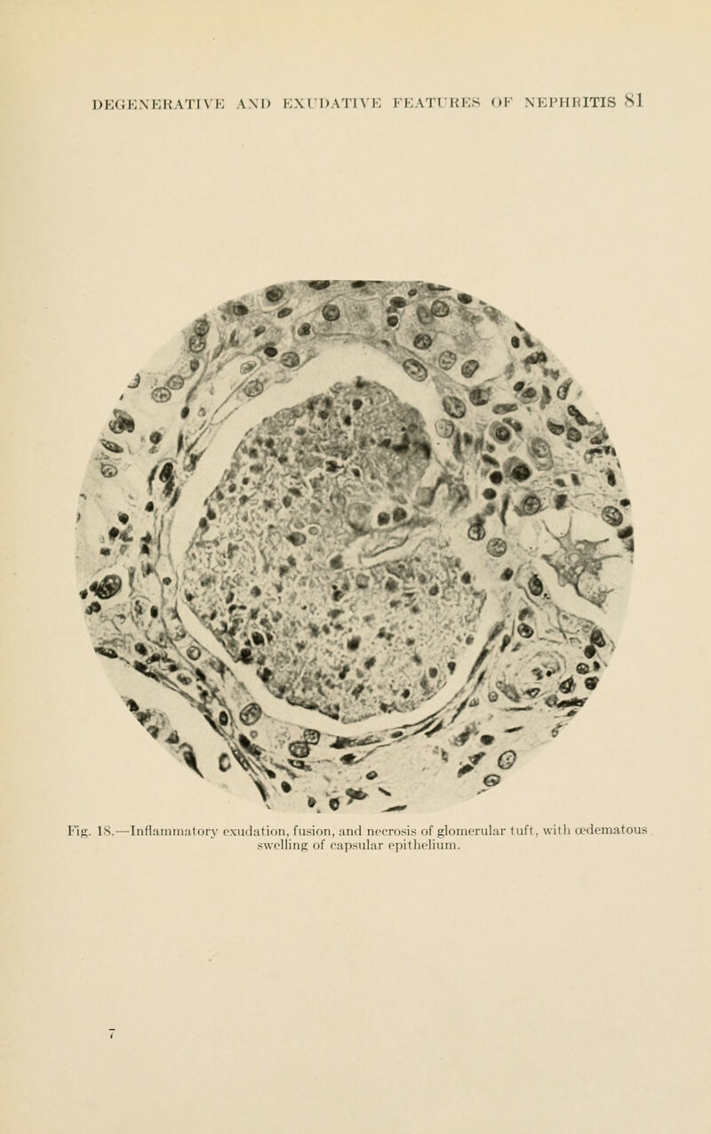 i0- ^ 6 JH Fig. IS.—IiifUunnmtory cxudiition, fusion, and nccro.'^is of glomerular tuft, with a'dematous swf'lling of capsular epitliolium.