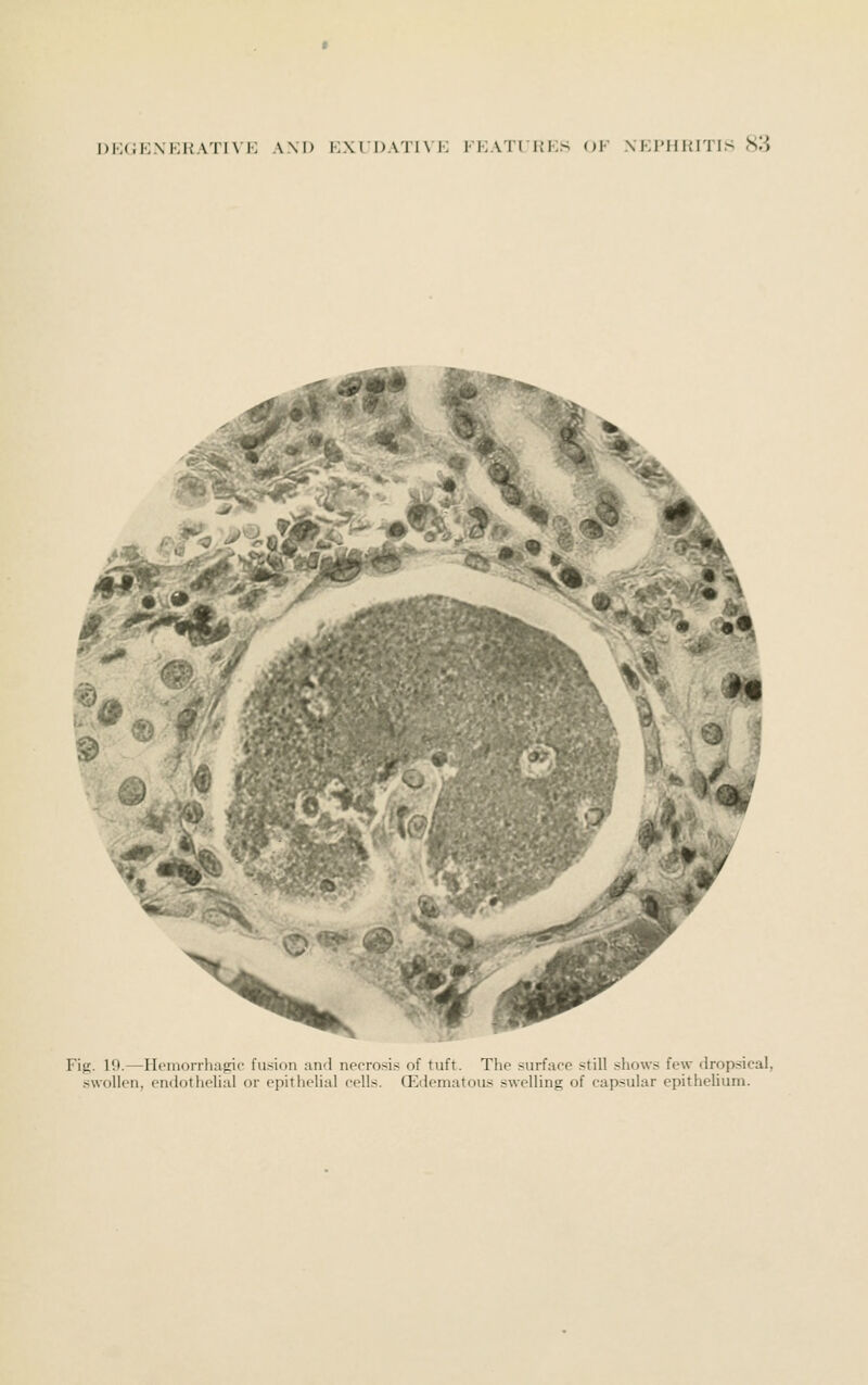 .»», © - ^'/ 9 ^ ® 4., / Fig. 19.—Iloniorrhagic fu-sion and nec-rosis of tuft. The surface still shows few drop.sical, swollen, endothelial or epithelial eells. Edematous swelling of capsular epithehum.