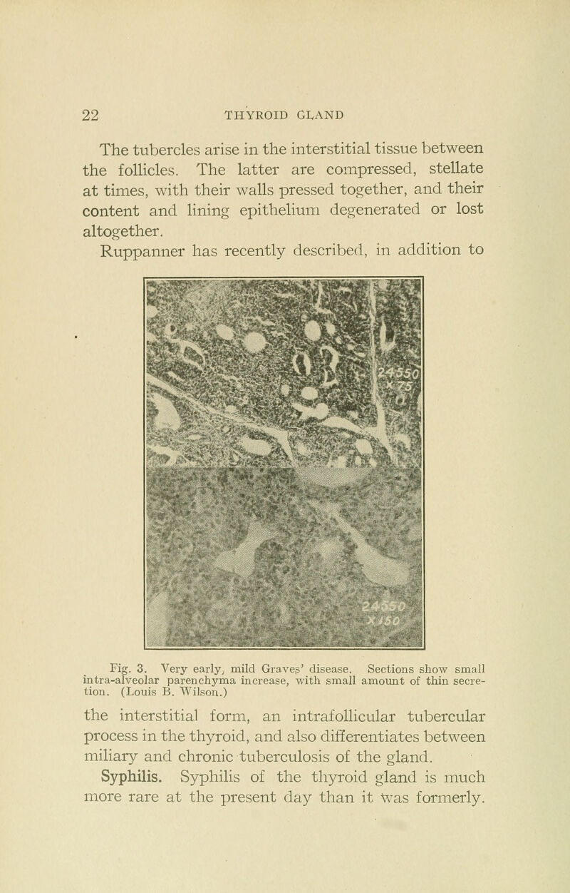 The tubercles arise in the interstitial tissue between the follicles. The latter are compressed, stellate at times, with their walls pressed together, and their content and lining epithelium degenerated or lost altogether. Ruppanner has recently described, in addition to Fig. 3. Very early; mild Graves' disease. Sections show small intra-alveolar parenchyma increase, with small amount of thin secre- tion. (Louis B. Wilson.) the interstitial form, an intrafollicular tubercular process in the thyroid, and also differentiates between miliary and chronic tuberculosis of the gland. Syphilis. Syphilis of the thyroid gland is much more rare at the present day than it Was formerly.