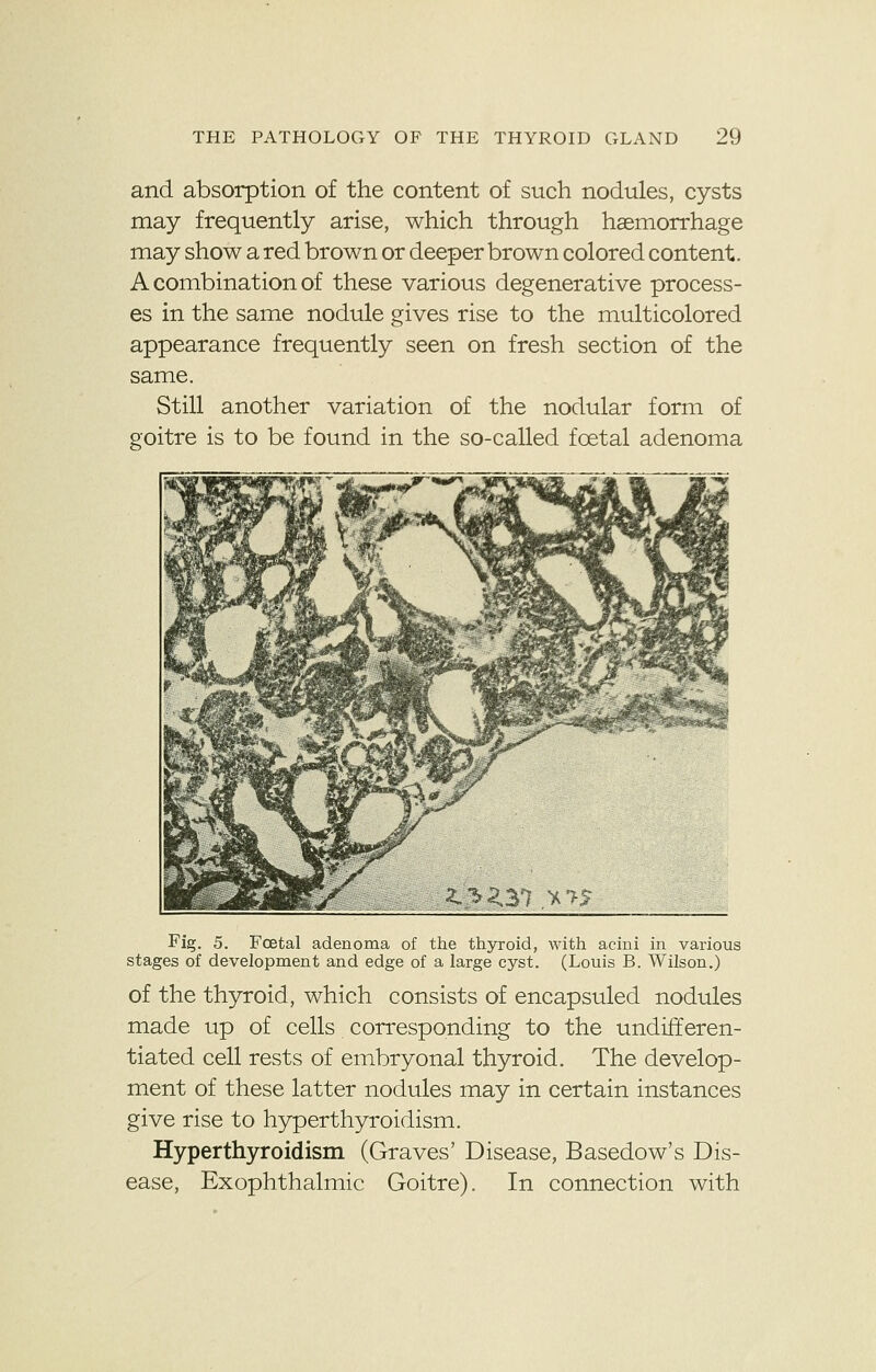 and. absorption of the content of such nodules, cysts may frequently arise, which through haemorrhage may show a red brown or deeper brown colored content. A combination of these various degenerative process- es in the same nodule gives rise to the multicolored appearance frequently seen on fresh section of the same. Still another variation of the nodular form of goitre is to be found in the so-called foetal adenoma Fig. 5. Foetal adenoma of the thyroid, with acini in various stages of development and edge of a large cyst. (Louis B. Wilson.) of the thyroid, which consists of encapsuled nodules made up of cells corresponding to the undifferen- tiated cell rests of embryonal thyroid. The develop- ment of these latter nodules may in certain instances give rise to hyperthyroidism. Hyperthyroidism (Graves' Disease, Basedow's Dis- ease, Exophthalmic Goitre). In connection with