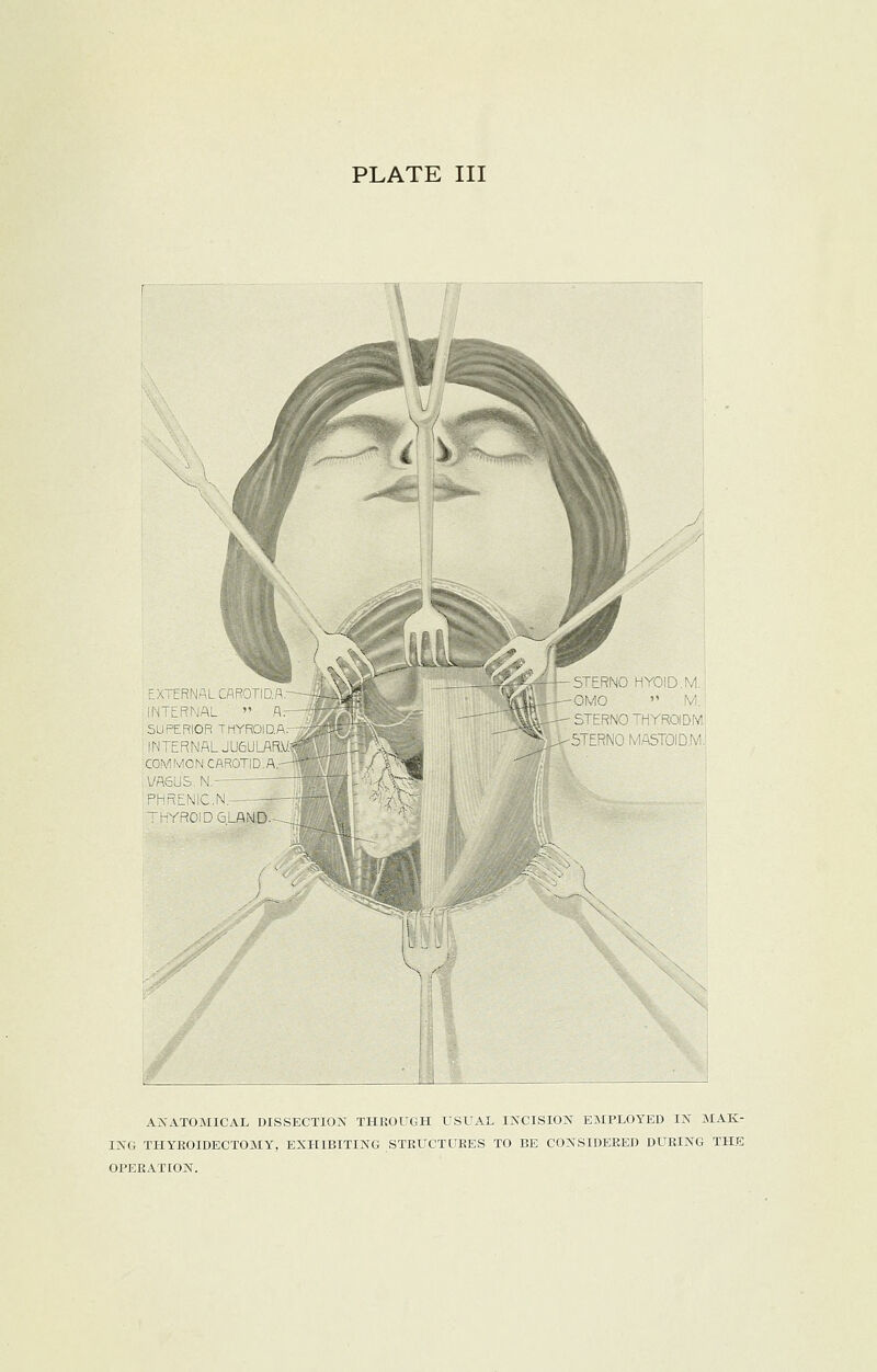 EXTERNAL CAROTIQ.A.- INTERNAL » A.~ SUPERIOR TMYROIDAr INTERNAL JUGULAR^ COMMON CAROTID A.— VA6US.N. PHRENIC.N. THYROID GLAND'.— STERNO HYOID.M. OMO  M. STERNO THYRCHDM, 3TERNO MASTOID^.! ANATOMICAL DISSECTION THROUGH USUAL INCISION EMPLOYED IN MAK- ING THYROIDECTOMY, EXHIBITING STRUCTURES TO BE CONSIDERED DURING THE OPERATION.