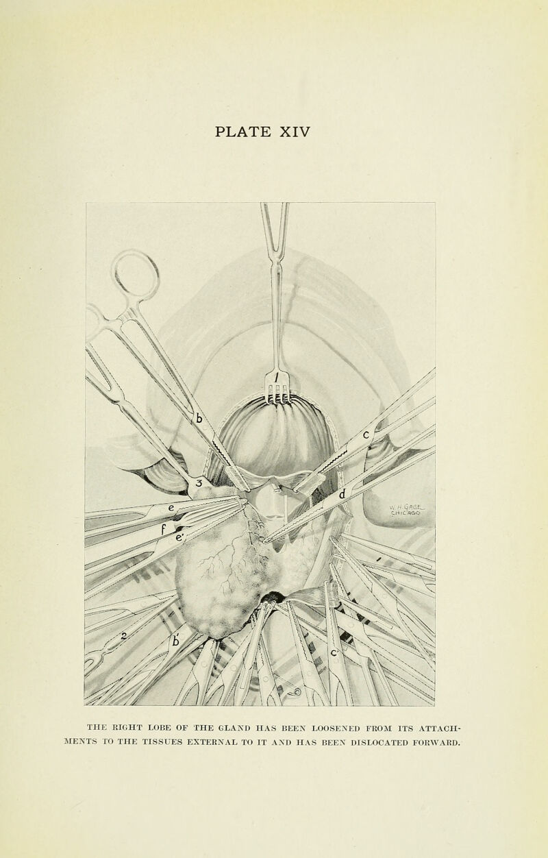 THE RIGHT LOBE OF THE GLAND HAS BEEN LOOSENED FROM ITS ATTACH- MENTS TO THE TISSUES EXTERNAL TO IT AND HAS BEEN DISLOCATED FORWARD.