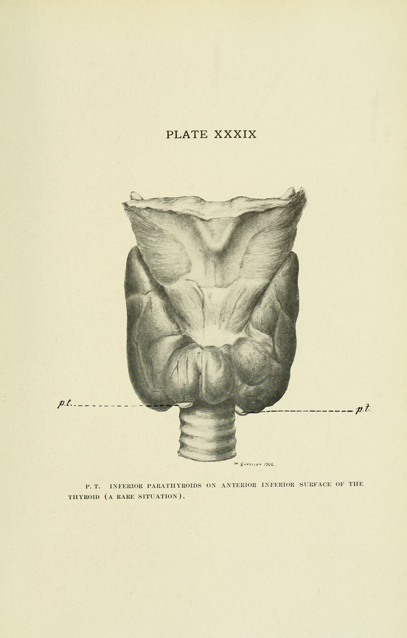 PLATE XXXIX p.t..__ P. T. INFERIOR PARATHYROIDS ON ANTERIOR INFERIOR SURFACE OF THE THYROID (A RARE SITUATION).