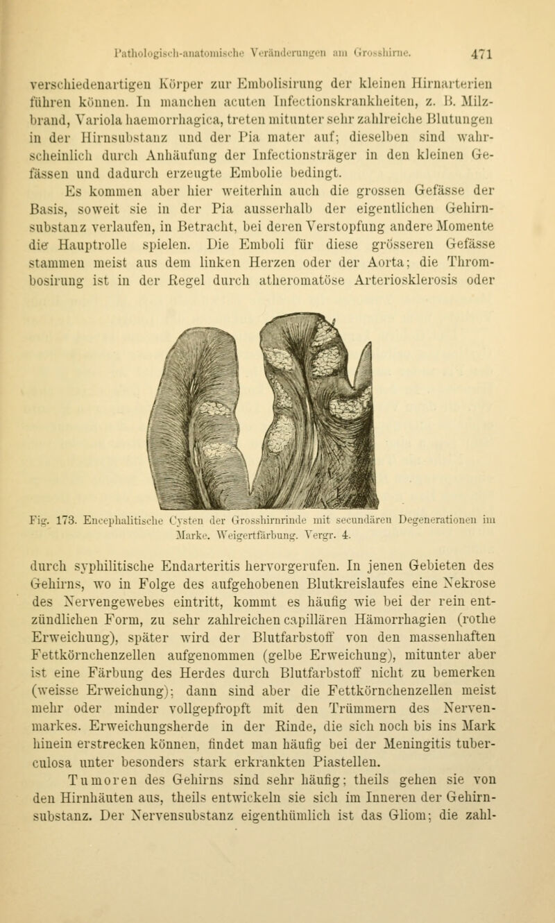 verscliiedenartigeu Körper zur P]mbolisirunj^ der kleinen Hirnarterien führen können. In manchen acuten Infectionskrankheiten, z. li. Milz- brand, Variola haemorrliagica, treten mitunter sehr zahlreiciie Blutungen in der Hirnsubstanz und der Pia mater auf; dieselben sind wahr- scheinlich durch Anhäufung der Infectionsträger in den kleinen Ge- fässeu und dadurch erzeugte Embolie bedingt. Es kommen aber hier weiterhin auch die grossen Gefässe der Basis, soweit sie in der Pia ausserhalb der eigentliclien Gehirn- substanz verlaufen, in Betracht, bei deren Verstopfung andere Momente dier Hauptrolle spielen. Die Emboli für diese grösseren Gefässe stammen meist aus dem linken Herzen oder der Aorta; die Throm- bosirung ist in der ßegel durch atheromatöse Arteriosklerosis oder Fiir. 173. EiKephalitisclie Cysten der Grosshirnrinde mit secundären Degenerationen im Marke. Weigertfärbuns^. Vergr. 4. durch syphilitische Endarteritis hervorgerufen. In jenen Gebieten des Gehirns, wo in Folge des aufgehobenen Blutkreislaufes eine Nekrose des Nervengewebes eintritt, kommt es häufig wie bei der rein ent- zündliehen Form, zu sehr zahlreichen capillären Hämorrhagien (rothe Erweichung), später wird der Blutfarbstoff von den massenhaften Fettkörnchenzellen aufgenommen (gelbe Erweichung), mitunter aber ist eine Färbung des Herdes durch Blutfarbstoff nicht zu bemerken (weisse Erweichung); dann sind aber die Fettkörnchenzellen meist mehr oder minder vollgepfropft mit den Trümmern des Nerven- markes. Erweichungsherde in der Rinde, die sich noch bis ins Mark hinein erstrecken können, findet man häufig bei der Meningitis tuber- culosa unter besonders stark erkrankten Piastellen. Tumoren des Gehirns sind sehr häufig; theils gehen sie von den Hirnhäuten aus, theils entwickeln sie sich im Inneren der Gehirn- substanz. Der Nervensubstanz eigenthümlich ist das Gliom; die zahl-