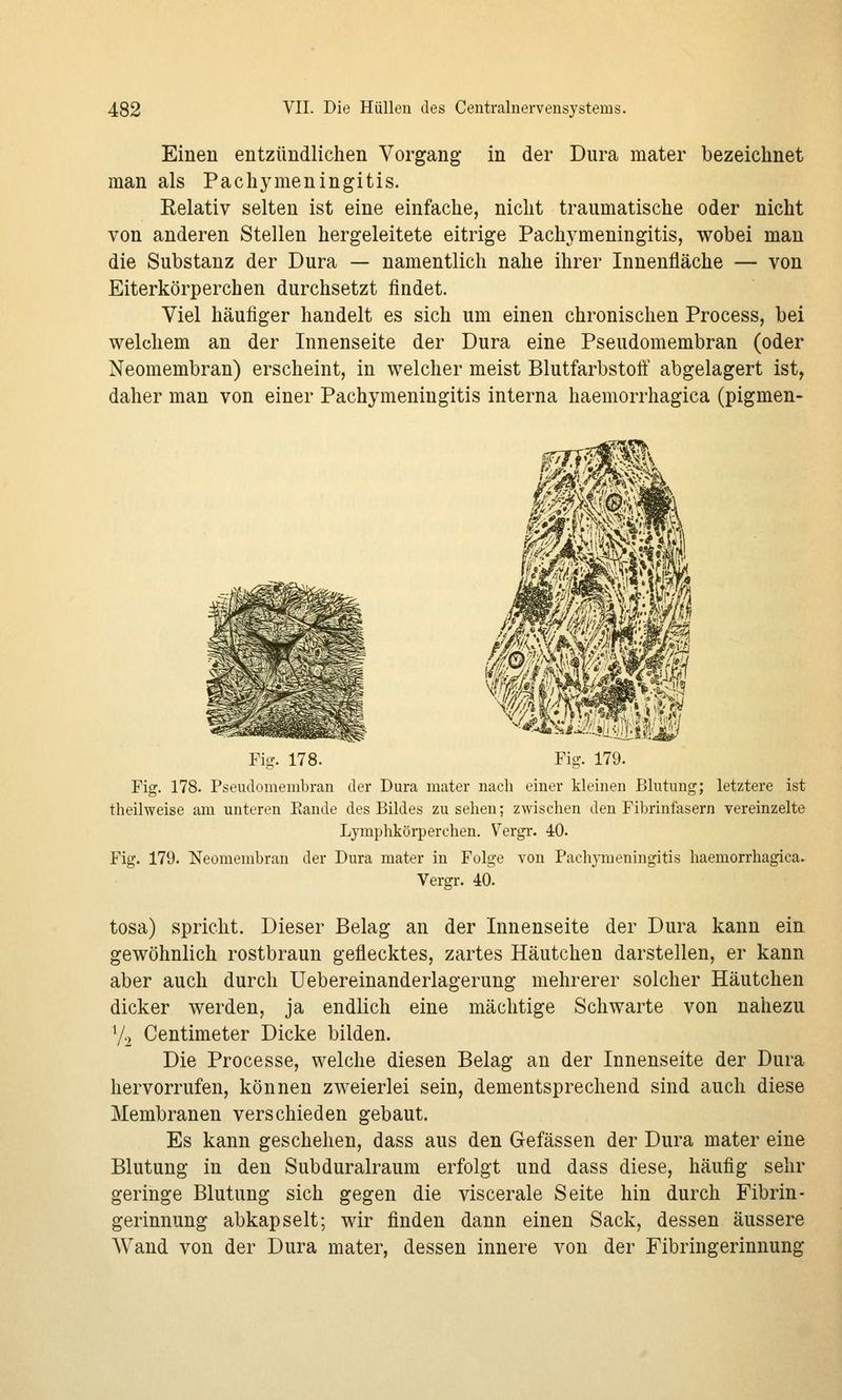Einen entzündlichen Vorgang in der Dura mater bezeichnet man als Pachymeningitis. Relativ selten ist eine einfache, nicht traumatische oder nicht von anderen Stellen hergeleitete eitrige Pachj^meningitis, wobei man die Substanz der Dura — namentlich nahe ihrer Innenfläche — von Eiterkörperchen durchsetzt findet. Viel häufiger handelt es sich um einen chronischen Process, bei welchem an der Innenseite der Dura eine Pseudomembran (oder Neomembran) erscheint, in welcher meist Blutfarbstoff abgelagert ist, daher man von einer Pachymeningitis interna haemorrhagica (pigmen- Fi^r. 178. Fig. 179. Fig. 178. Pseudomembran der Dura mater nach einer kleinen Blutung; letztere ist theilweise am unteren Eande des Bildes zusehen; zwischen den Fibrinfasern vereinzelte Lymphkörperchen. Vergr. 40. Fig. 179. Neomembran der Dura mater in Folge von Pachymeningitis haemorrhagica» Vergr. 40. tosa) spricht. Dieser Belag an der Innenseite der Dura kann ein gewöhnlich rostbraun geflecktes, zartes Häutchen darstellen, er kann aber auch durch Uebereinanderlagerung mehrerer solcher Häutchen dicker werden, ja endlich eine mächtige Schwarte von nahezu V2 Centimeter Dicke bilden. Die Processe, welche diesen Belag an der Innenseite der Dura hervorrufen, können zweierlei sein, dementsprechend sind auch diese Membranen verschieden gebaut. Es kann geschehen, dass aus den Gefässen der Dura mater eine Blutung in den Subduralraum erfolgt und dass diese, häufig sehr geringe Blutung sich gegen die viscerale Seite hin durch Fibrin- gerinnung abkapselt; wir finden dann einen Sack, dessen äussere Wand von der Dura mater, dessen innere von der Fibringerinnung