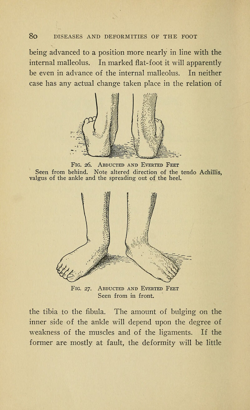 being advanced to a position more nearly in line with the internal malleolus. In marked flat-foot it will apparently be even in advance of the internal malleolus. In neither case has any actual change taken place in the relation of Fig. 26, Abducted and Everted Feet Seen from behind. Note altered direction of the tendo Achillis, valgus of the ankle and the spreading out of the heel. Fig. 27. Abducted and Everted Feet Seen from in front. the tibia to the fibula. The amount of bulging on the inner side of the ankle will depend upon the degree of weakness of the muscles and of the ligaments. If the former are mostly at fault, the deformity will be little