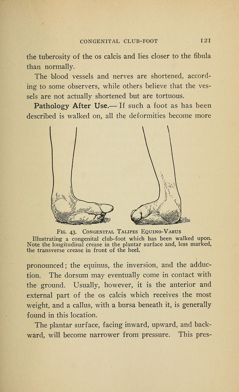 the tuberosity of the os calcis and lies closer to the fibula than normally. The blood vessels and nerves are shortened, accord- ing to some observers, while others believe that the ves- sels are not actually shortened but are tortuous. Pathology After Use.— If such a foot as has been described is walked on, all the deformities become more Fig. 43. Congenital Talipes Equino-Varus Illustrating a congenital club-foot which has been walked upon. Note the longitudinal crease in the plantar surface and, less marked, the transverse crease in front of the heel. pronounced; the equinus, the inversion, and the adduc- tion. The dorsum may eventually come in contact with the ground. Usually, however, it is the anterior and external part of the os calcis which receives the most weight, and a callus, with a bursa beneath it, is generally found in this location. The plantar surface, facing inward, upward, and back- ward, will become narrower from pressure. This pres-