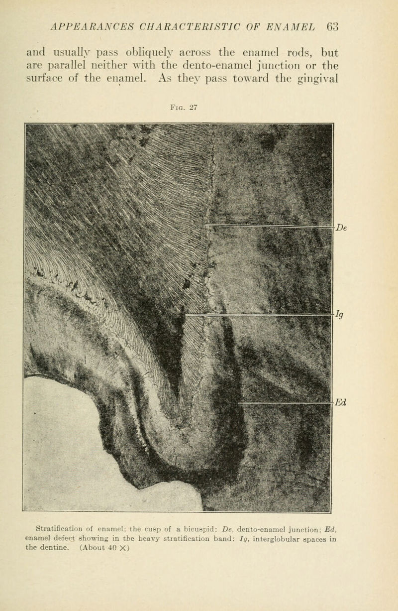 and usually pass obliquely across the enamel rods, but are parallel neither with the dento-enamel junction or the surface of the enamel. As they pass toward the gingival Fig. 27 Stratification of enamel: the cusp of a bicuspid: De. dento-enamel junction: Ed, enamel defecj showing in the heavj' stratification band; Ig, interglobular spaces in the dentine. (About 40 X)