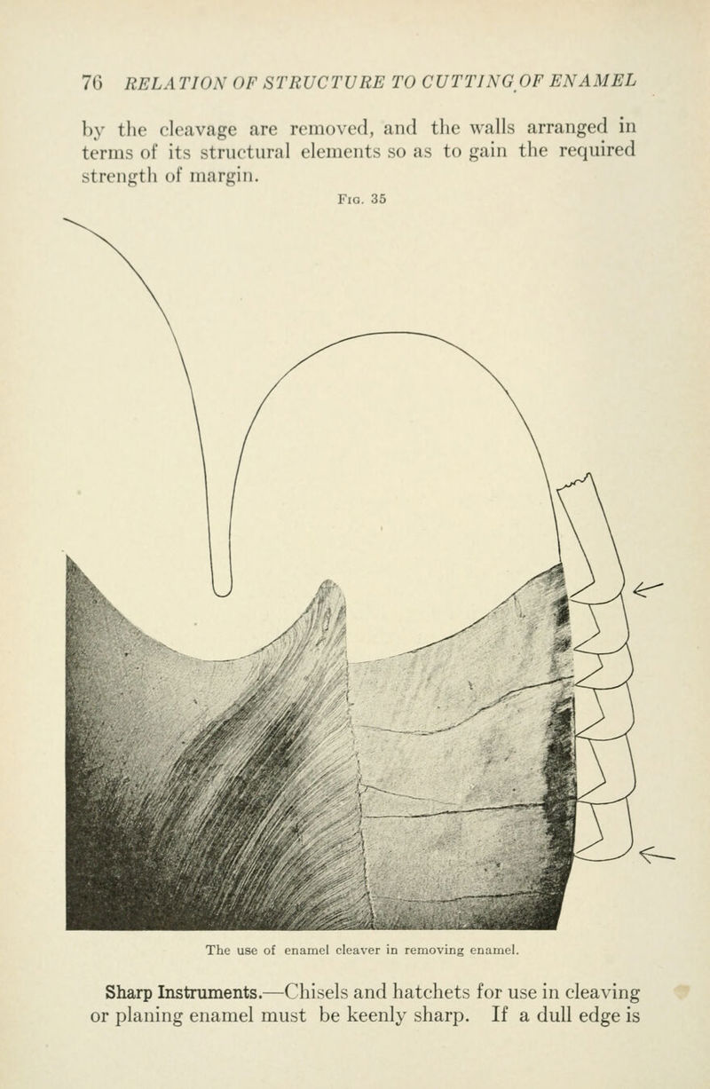 by the cleavage are removed, and the walls arranged in terms of its structural elements so as to gain the required strength of margin. Fig. 35 ^— The use of enamel cleaver in removing enamel. Sharp Instruments.—Chisels and hatchets for use in cleaving or planing enamel must be keenly sharp. If a dull edge is